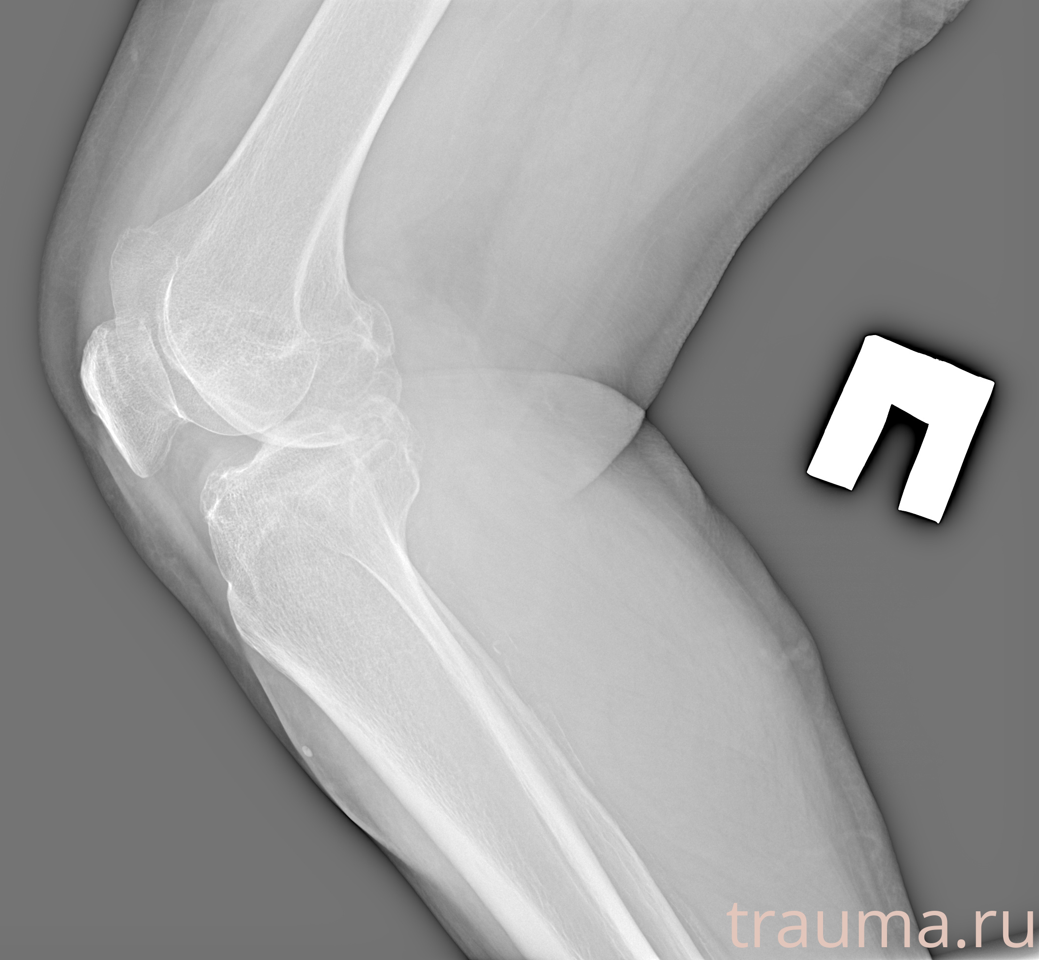 Рентген на дому: по вашему адресу приезжает врач-рентгенолог, травматолог-ортопед с мобильным рентгеновским аппаратом, проводит диагностику травмы или заболевания, делает необходимые рентгенограммы, дает рекомендации по дальнейшему лечению. Получить качественные снимки в домашних условиях возможно благодаря уникальной методике, разработанной МосРентген Центром для института  Склифосовского