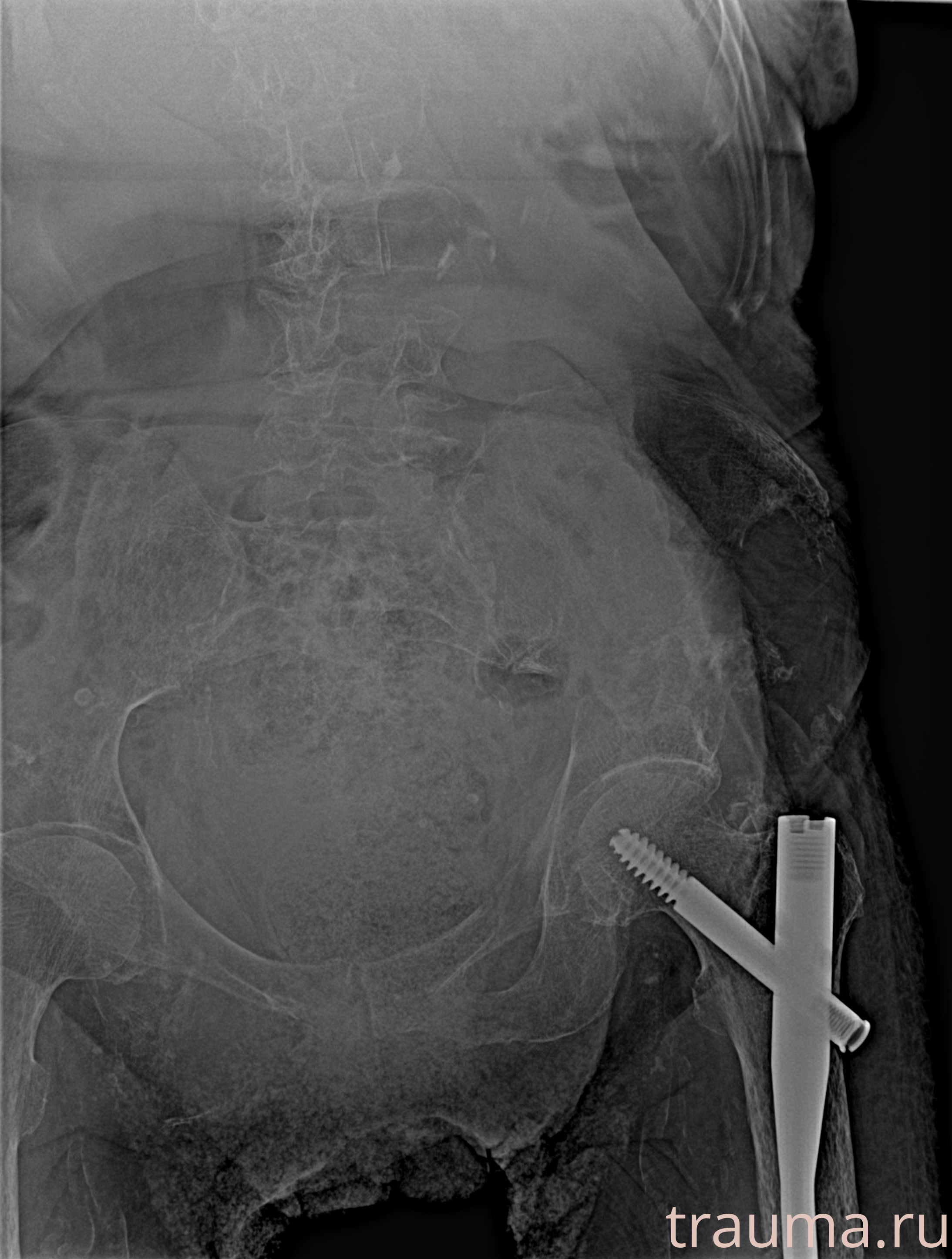 Рентген на дому: по вашему адресу приезжает врач-рентгенолог, травматолог-ортопед с мобильным рентгеновским аппаратом, проводит диагностику травмы или заболевания, делает необходимые рентгенограммы, дает рекомендации по дальнейшему лечению. Получить качественные снимки в домашних условиях возможно благодаря уникальной методике, разработанной МосРентген Центром для института  Склифосовского