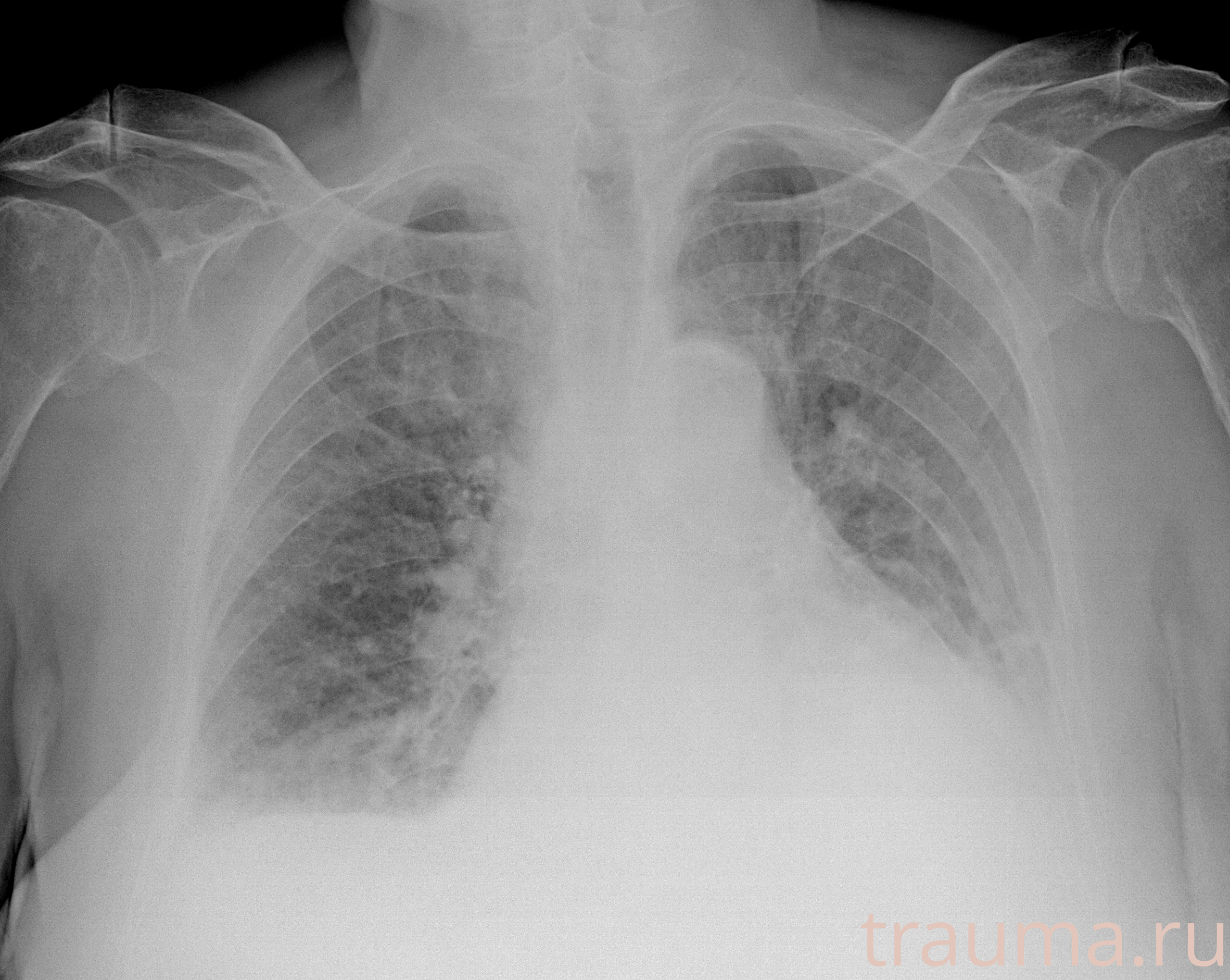 Рентген на дому: по вашему адресу приезжает врач-рентгенолог, травматолог-ортопед с мобильным рентгеновским аппаратом, проводит диагностику травмы или заболевания, делает необходимые рентгенограммы, дает рекомендации по дальнейшему лечению. Получить качественные снимки в домашних условиях возможно благодаря уникальной методике, разработанной МосРентген Центром для института  Склифосовского