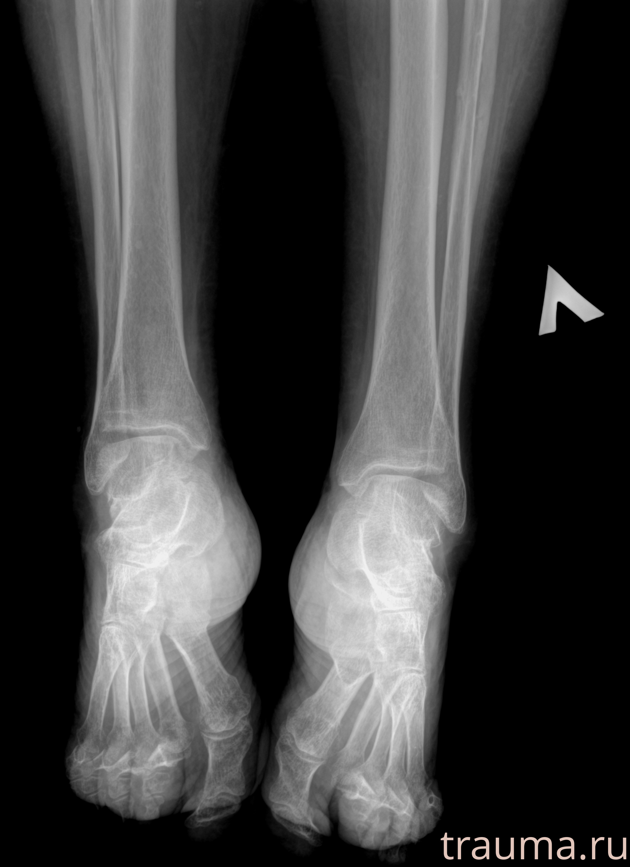 Рентген на дому: по вашему адресу приезжает врач-рентгенолог, травматолог-ортопед с мобильным рентгеновским аппаратом, проводит диагностику травмы или заболевания, делает необходимые рентгенограммы, дает рекомендации по дальнейшему лечению. Получить качественные снимки в домашних условиях возможно благодаря уникальной методике, разработанной МосРентген Центром для института  Склифосовского