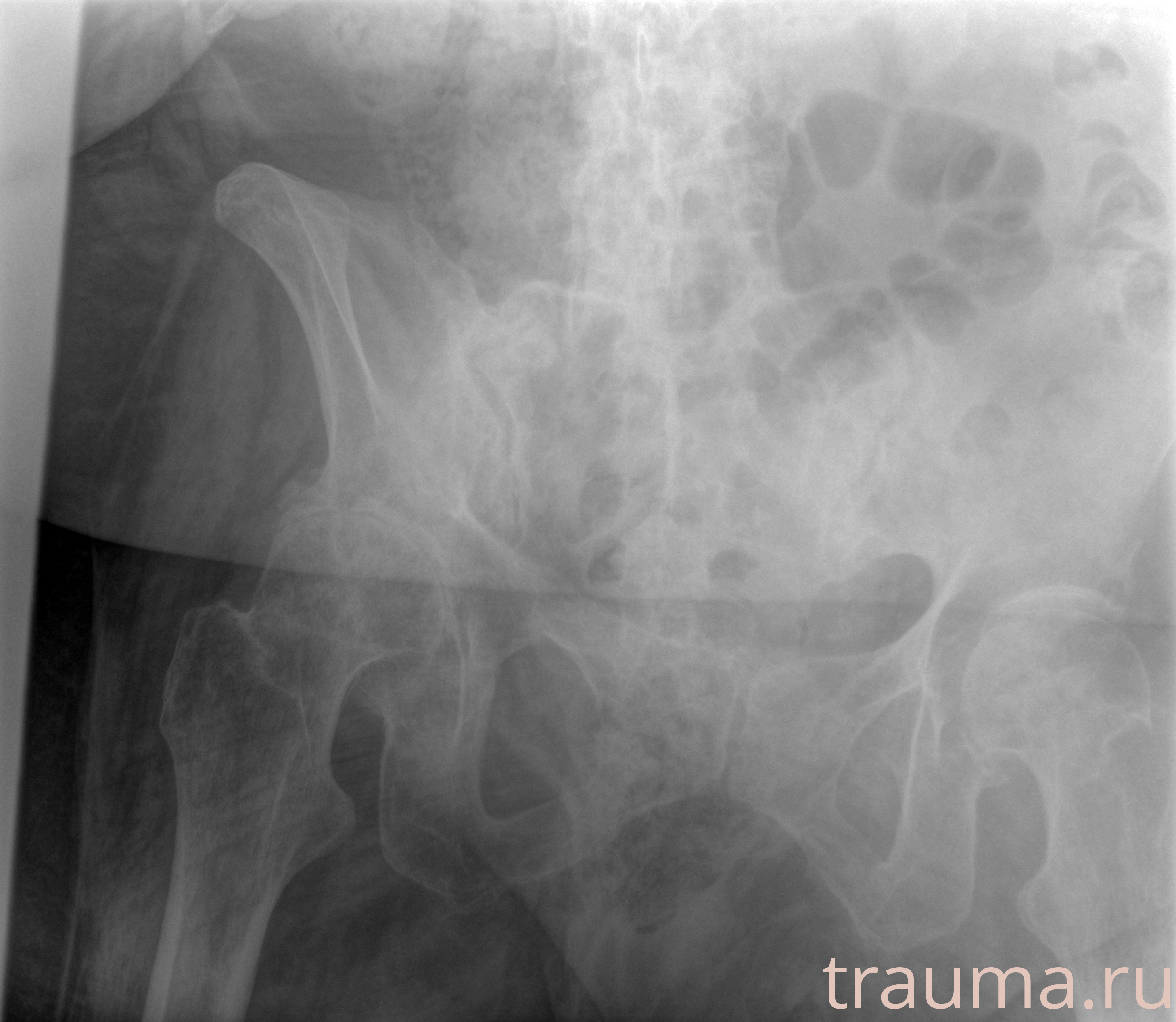 Рентген на дому: по вашему адресу приезжает врач-рентгенолог, травматолог-ортопед с мобильным рентгеновским аппаратом, проводит диагностику травмы или заболевания, делает необходимые рентгенограммы, дает рекомендации по дальнейшему лечению. Получить качественные снимки в домашних условиях возможно благодаря уникальной методике, разработанной МосРентген Центром для института  Склифосовского