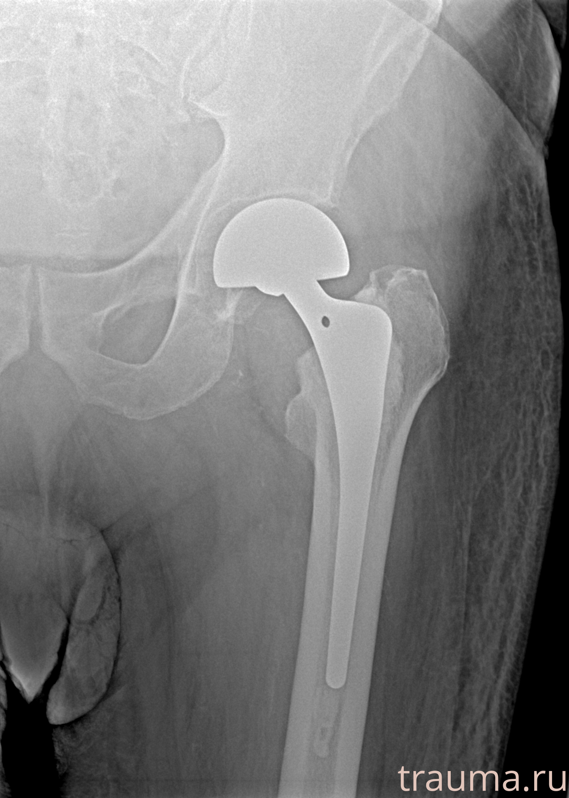 Рентген на дому: по вашему адресу приезжает врач-рентгенолог, травматолог-ортопед с мобильным рентгеновским аппаратом, проводит диагностику травмы или заболевания, делает необходимые рентгенограммы, дает рекомендации по дальнейшему лечению. Получить качественные снимки в домашних условиях возможно благодаря уникальной методике, разработанной МосРентген Центром для института  Склифосовского