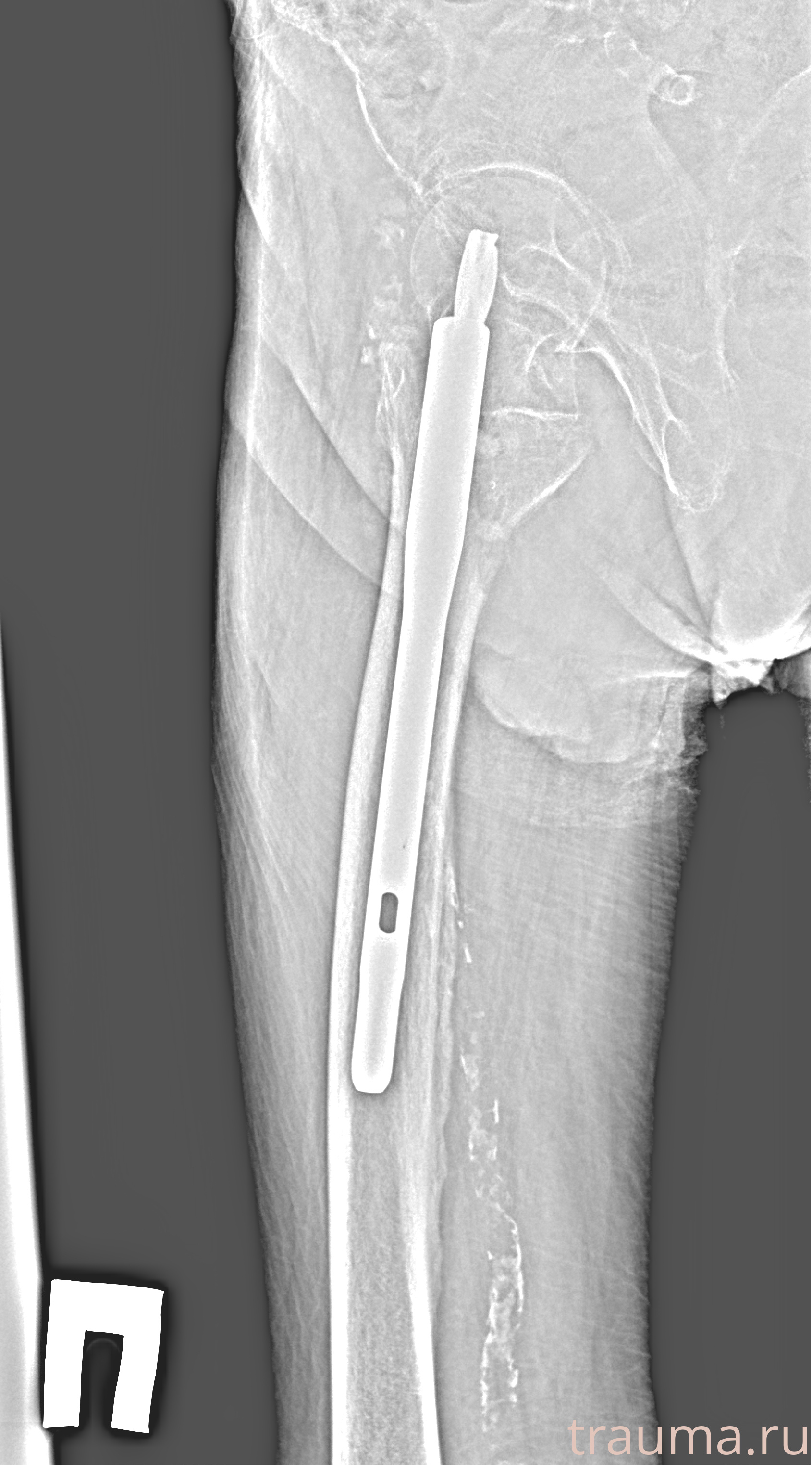 Рентген на дому: по вашему адресу приезжает врач-рентгенолог, травматолог-ортопед с мобильным рентгеновским аппаратом, проводит диагностику травмы или заболевания, делает необходимые рентгенограммы, дает рекомендации по дальнейшему лечению. Получить качественные снимки в домашних условиях возможно благодаря уникальной методике, разработанной МосРентген Центром для института  Склифосовского
