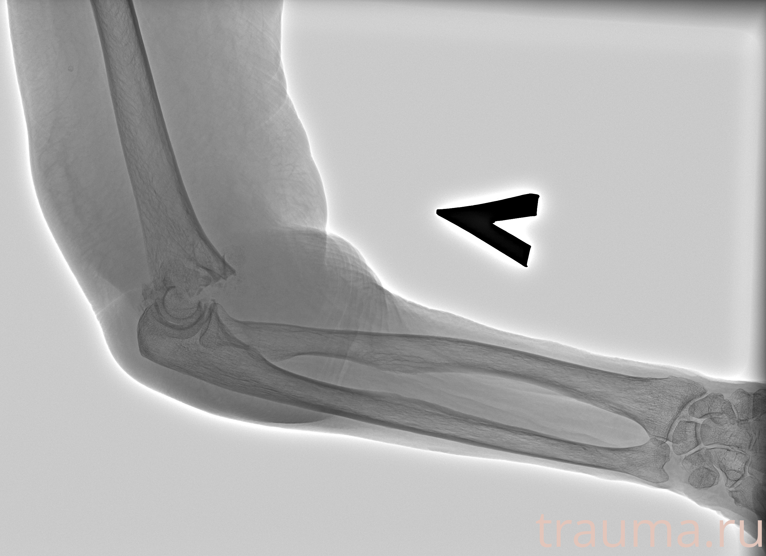 Рентген на дому: по вашему адресу приезжает врач-рентгенолог, травматолог-ортопед с мобильным рентгеновским аппаратом, проводит диагностику травмы или заболевания, делает необходимые рентгенограммы, дает рекомендации по дальнейшему лечению. Получить качественные снимки в домашних условиях возможно благодаря уникальной методике, разработанной МосРентген Центром для института  Склифосовского