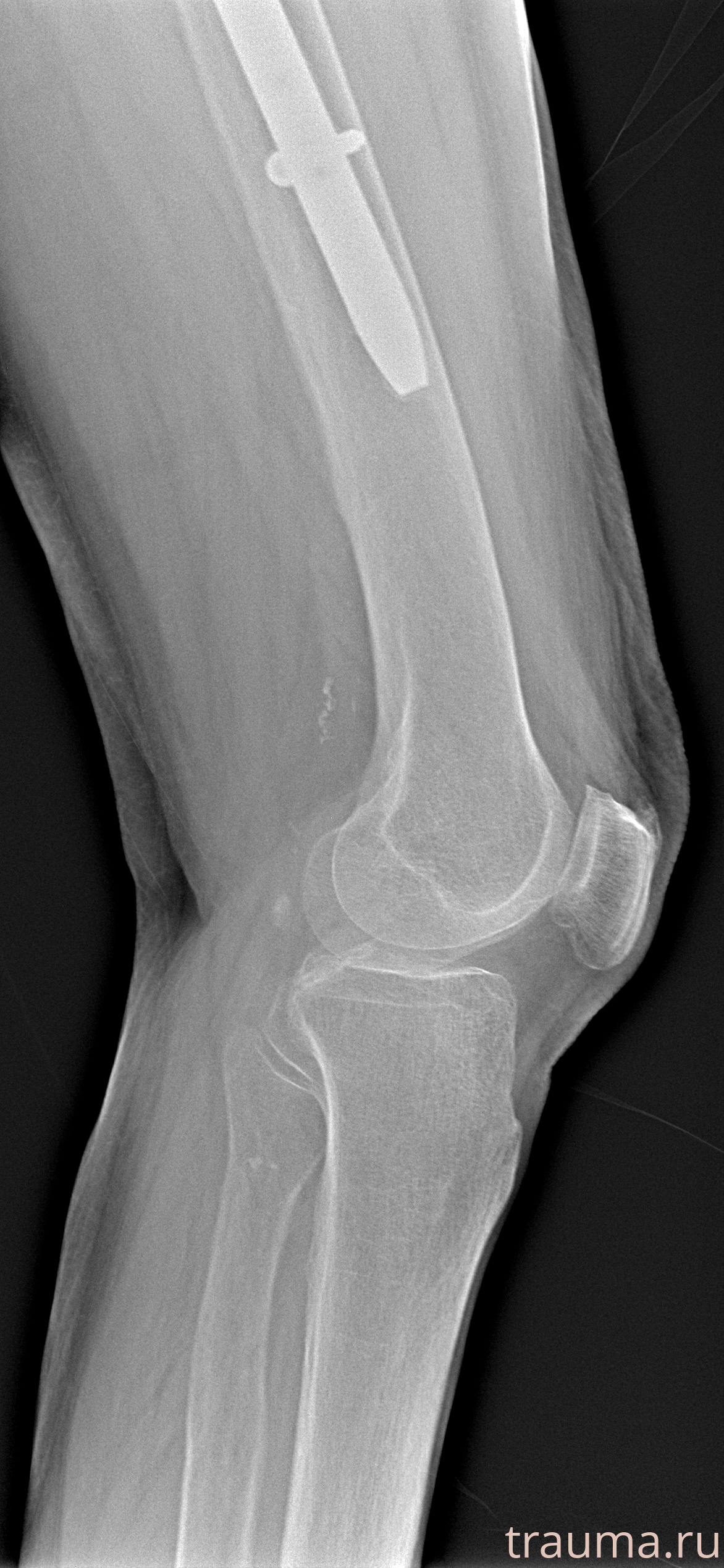 Рентген на дому: по вашему адресу приезжает врач-рентгенолог, травматолог-ортопед с мобильным рентгеновским аппаратом, проводит диагностику травмы или заболевания, делает необходимые рентгенограммы, дает рекомендации по дальнейшему лечению. Получить качественные снимки в домашних условиях возможно благодаря уникальной методике, разработанной МосРентген Центром для института  Склифосовского