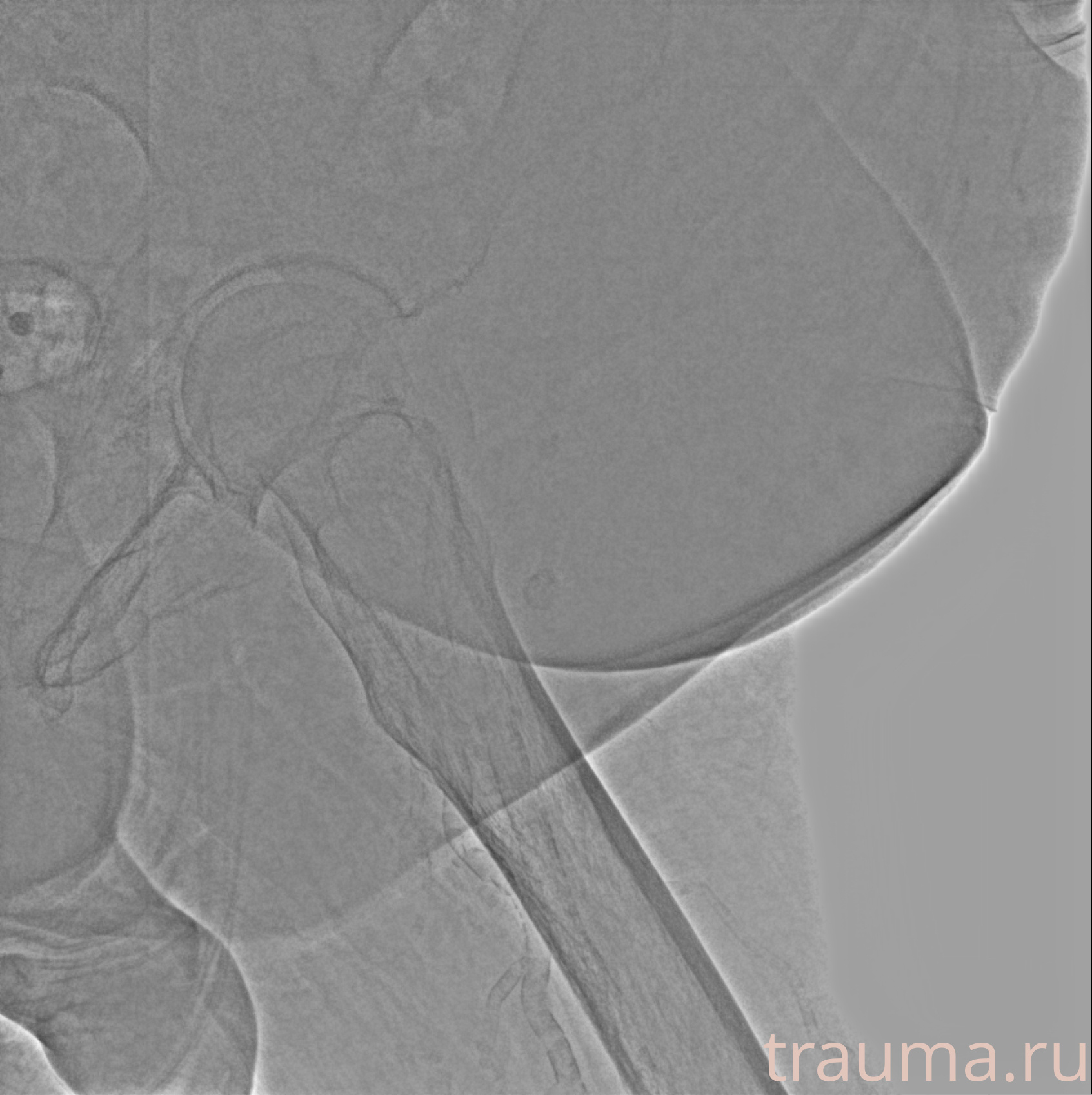 Рентген на дому: по вашему адресу приезжает врач-рентгенолог, травматолог-ортопед с мобильным рентгеновским аппаратом, проводит диагностику травмы или заболевания, делает необходимые рентгенограммы, дает рекомендации по дальнейшему лечению. Получить качественные снимки в домашних условиях возможно благодаря уникальной методике, разработанной МосРентген Центром для института  Склифосовского