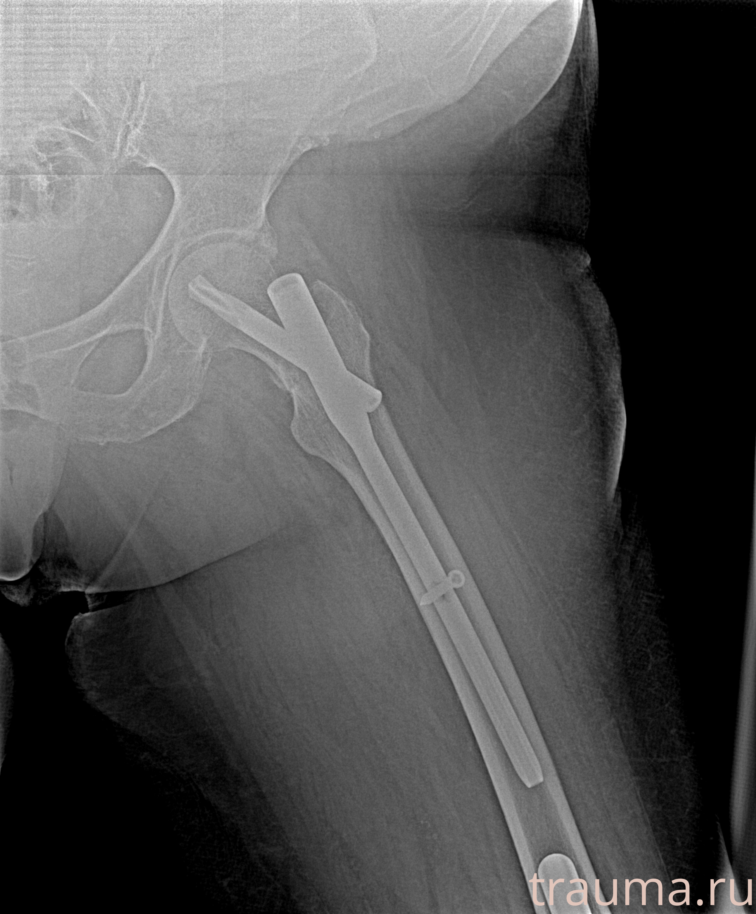 Рентген на дому: по вашему адресу приезжает врач-рентгенолог, травматолог-ортопед с мобильным рентгеновским аппаратом, проводит диагностику травмы или заболевания, делает необходимые рентгенограммы, дает рекомендации по дальнейшему лечению. Получить качественные снимки в домашних условиях возможно благодаря уникальной методике, разработанной МосРентген Центром для института  Склифосовского