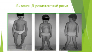 МРТ и КТ визуализация последствий рахита и витамин D-резистентного рахита МРТ и КТ визуализация последствий рахита и витамин D-резистентного рахита