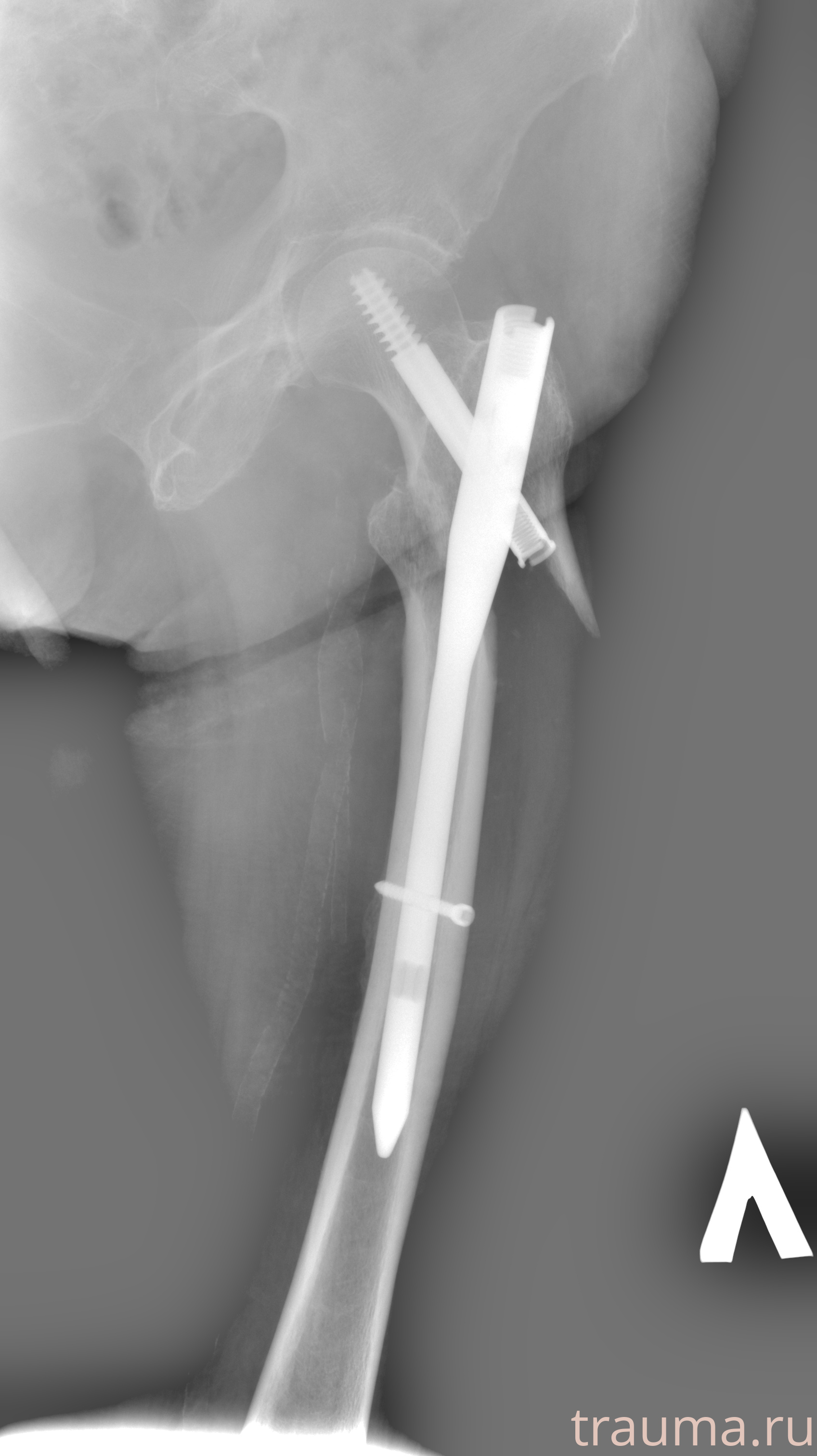 Рентген на дому: по вашему адресу приезжает врач-рентгенолог, травматолог-ортопед с мобильным рентгеновским аппаратом, проводит диагностику травмы или заболевания, делает необходимые рентгенограммы, дает рекомендации по дальнейшему лечению. Получить качественные снимки в домашних условиях возможно благодаря уникальной методике, разработанной МосРентген Центром для института  Склифосовского