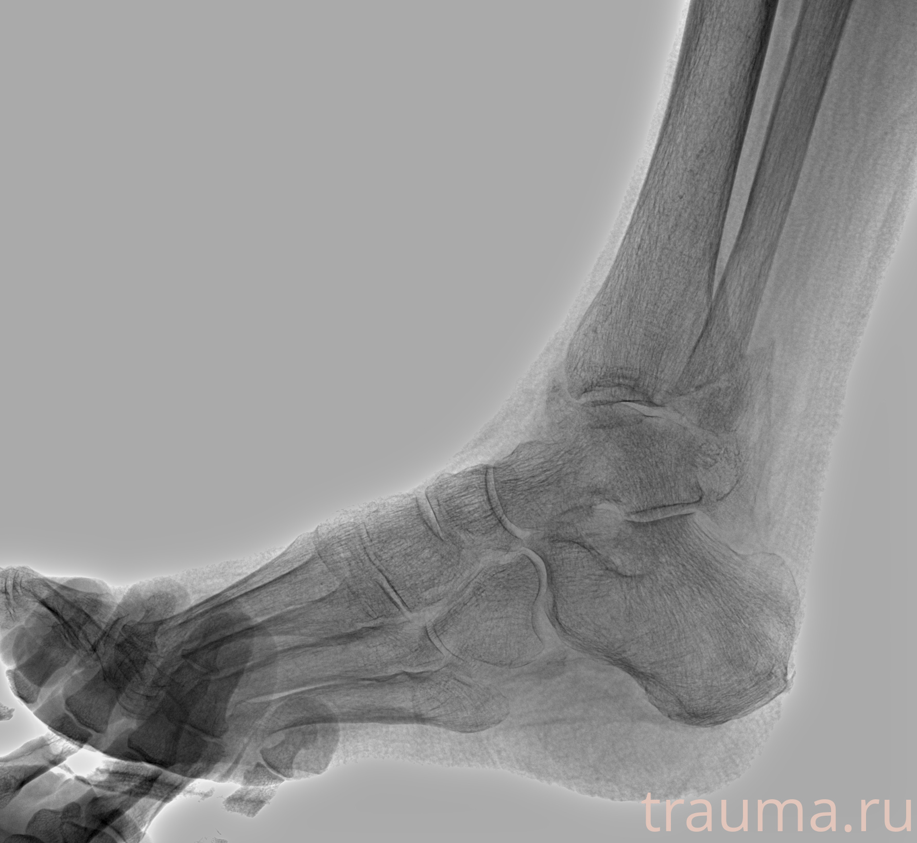 Рентген на дому: по вашему адресу приезжает врач-рентгенолог, травматолог-ортопед с мобильным рентгеновским аппаратом, проводит диагностику травмы или заболевания, делает необходимые рентгенограммы, дает рекомендации по дальнейшему лечению. Получить качественные снимки в домашних условиях возможно благодаря уникальной методике, разработанной МосРентген Центром для института  Склифосовского