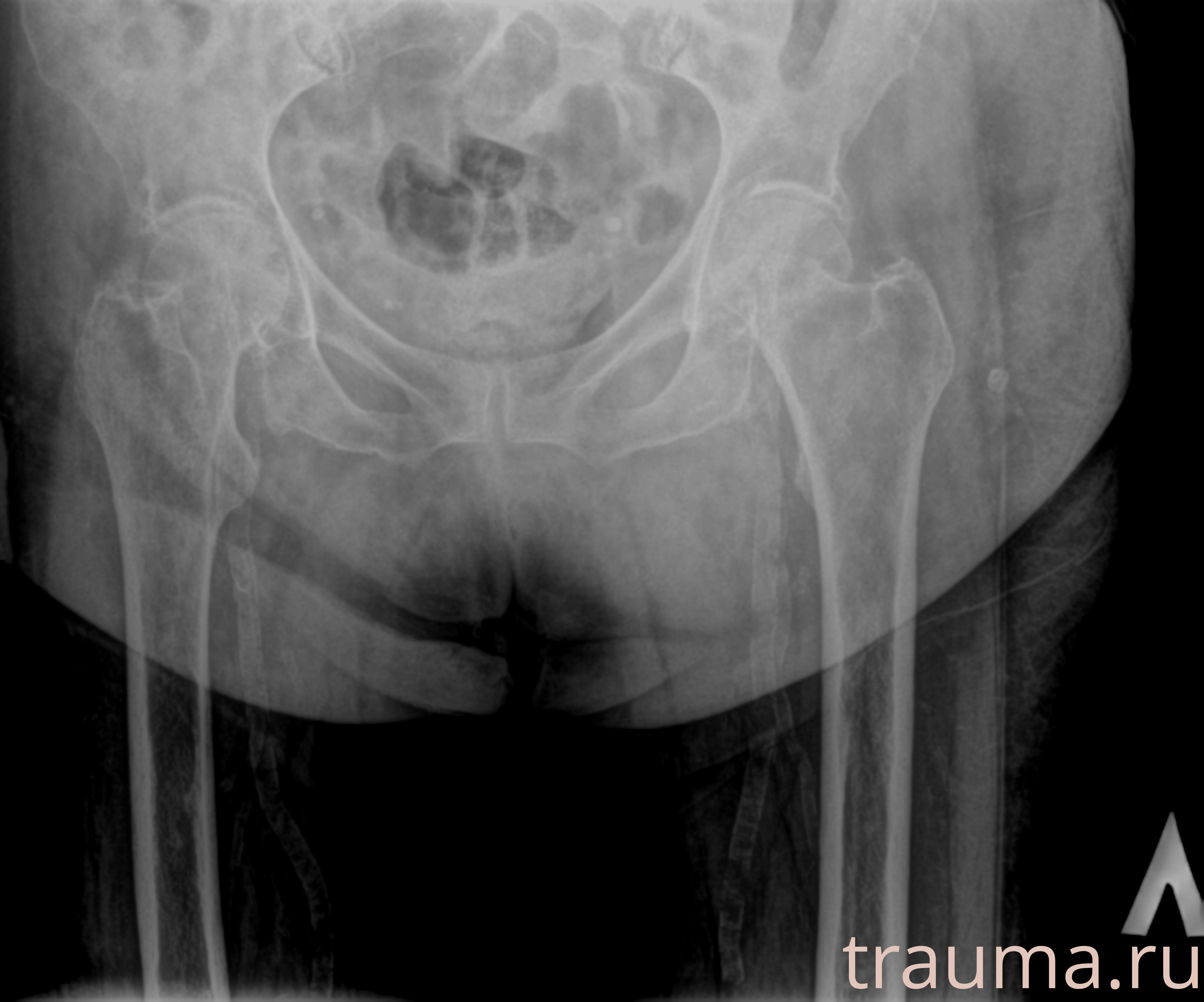 Рентген на дому: по вашему адресу приезжает врач-рентгенолог, травматолог-ортопед с мобильным рентгеновским аппаратом, проводит диагностику травмы или заболевания, делает необходимые рентгенограммы, дает рекомендации по дальнейшему лечению. Получить качественные снимки в домашних условиях возможно благодаря уникальной методике, разработанной МосРентген Центром для института  Склифосовского