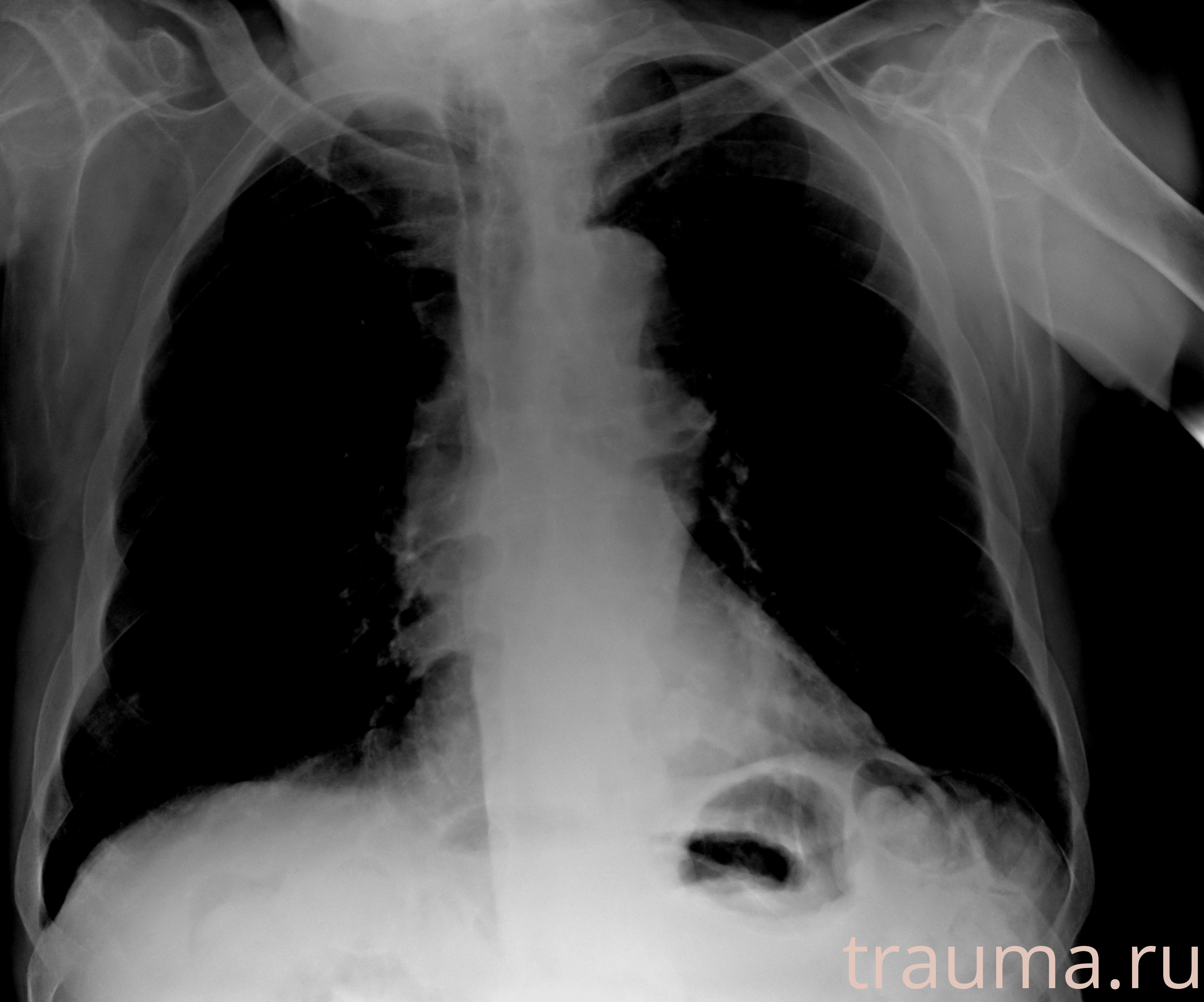 Рентген на дому: по вашему адресу приезжает врач-рентгенолог, травматолог-ортопед с мобильным рентгеновским аппаратом, проводит диагностику травмы или заболевания, делает необходимые рентгенограммы, дает рекомендации по дальнейшему лечению. Получить качественные снимки в домашних условиях возможно благодаря уникальной методике, разработанной МосРентген Центром для института  Склифосовского