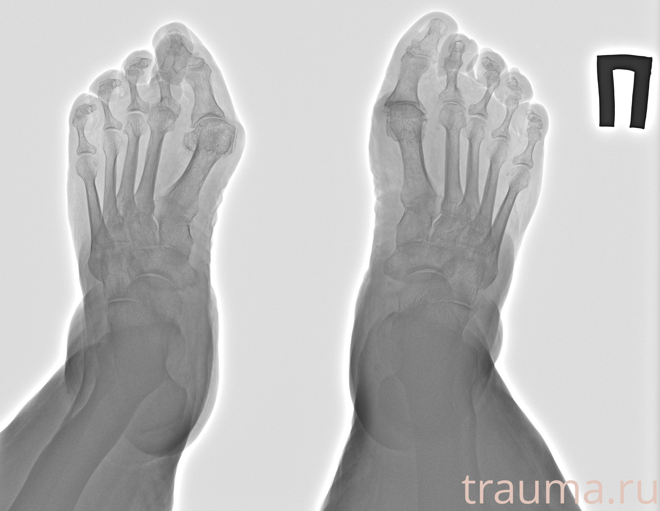 Рентген на дому: по вашему адресу приезжает врач-рентгенолог, травматолог-ортопед с мобильным рентгеновским аппаратом, проводит диагностику травмы или заболевания, делает необходимые рентгенограммы, дает рекомендации по дальнейшему лечению. Получить качественные снимки в домашних условиях возможно благодаря уникальной методике, разработанной МосРентген Центром для института  Склифосовского