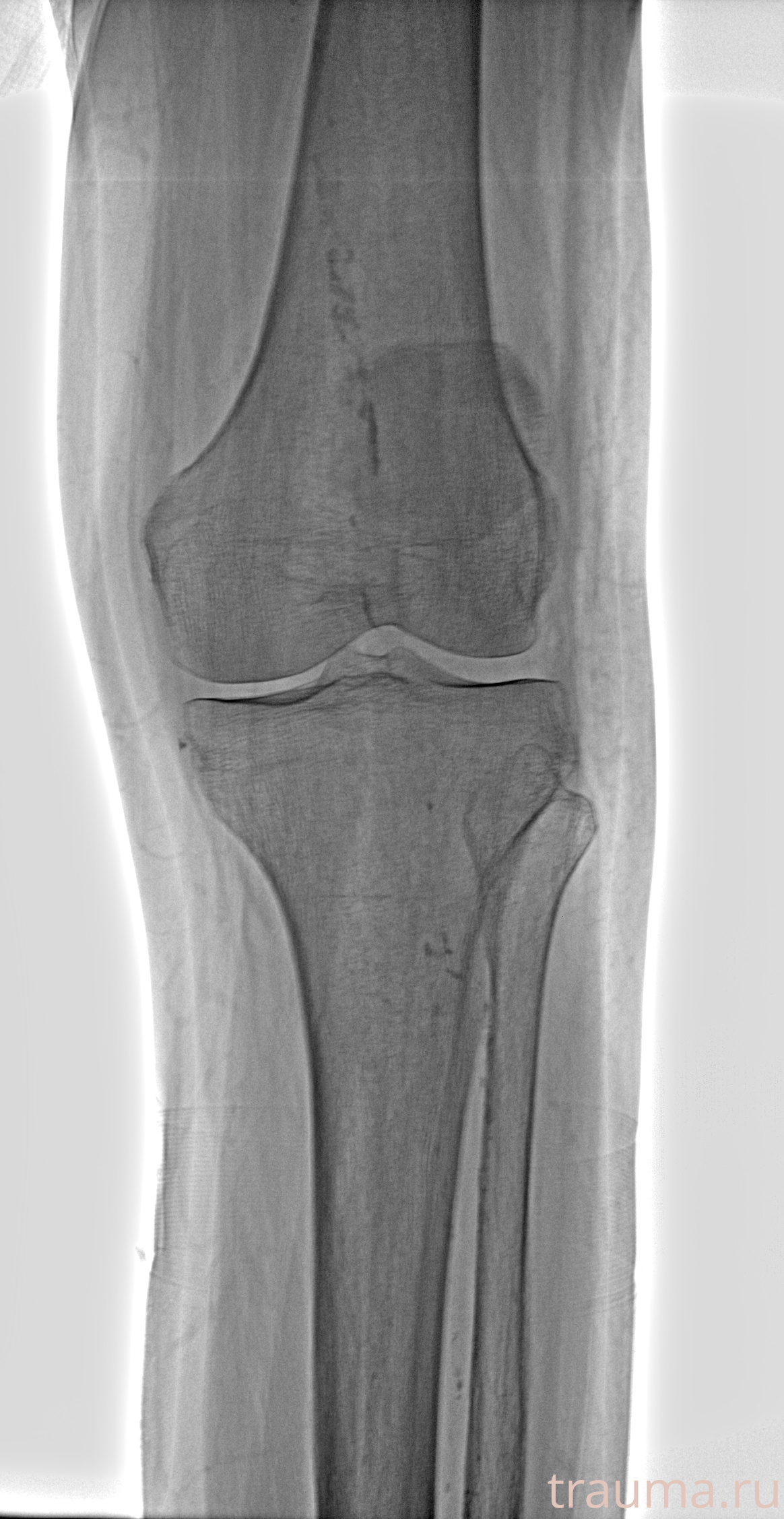 Рентген на дому: по вашему адресу приезжает врач-рентгенолог, травматолог-ортопед с мобильным рентгеновским аппаратом, проводит диагностику травмы или заболевания, делает необходимые рентгенограммы, дает рекомендации по дальнейшему лечению. Получить качественные снимки в домашних условиях возможно благодаря уникальной методике, разработанной МосРентген Центром для института  Склифосовского