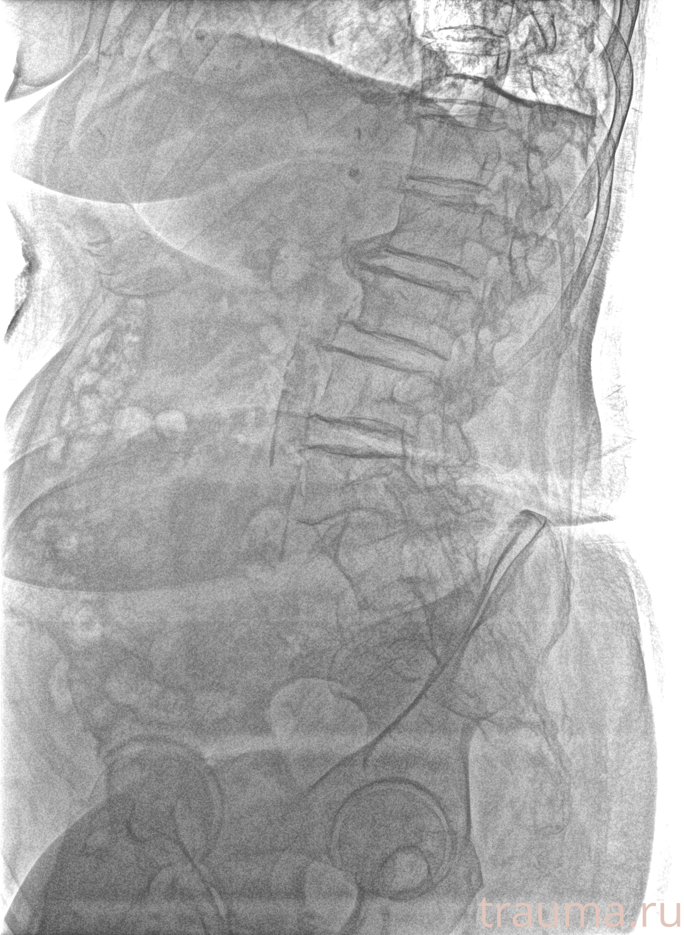 Рентген на дому: по вашему адресу приезжает врач-рентгенолог, травматолог-ортопед с мобильным рентгеновским аппаратом, проводит диагностику травмы или заболевания, делает необходимые рентгенограммы, дает рекомендации по дальнейшему лечению. Получить качественные снимки в домашних условиях возможно благодаря уникальной методике, разработанной МосРентген Центром для института  Склифосовского