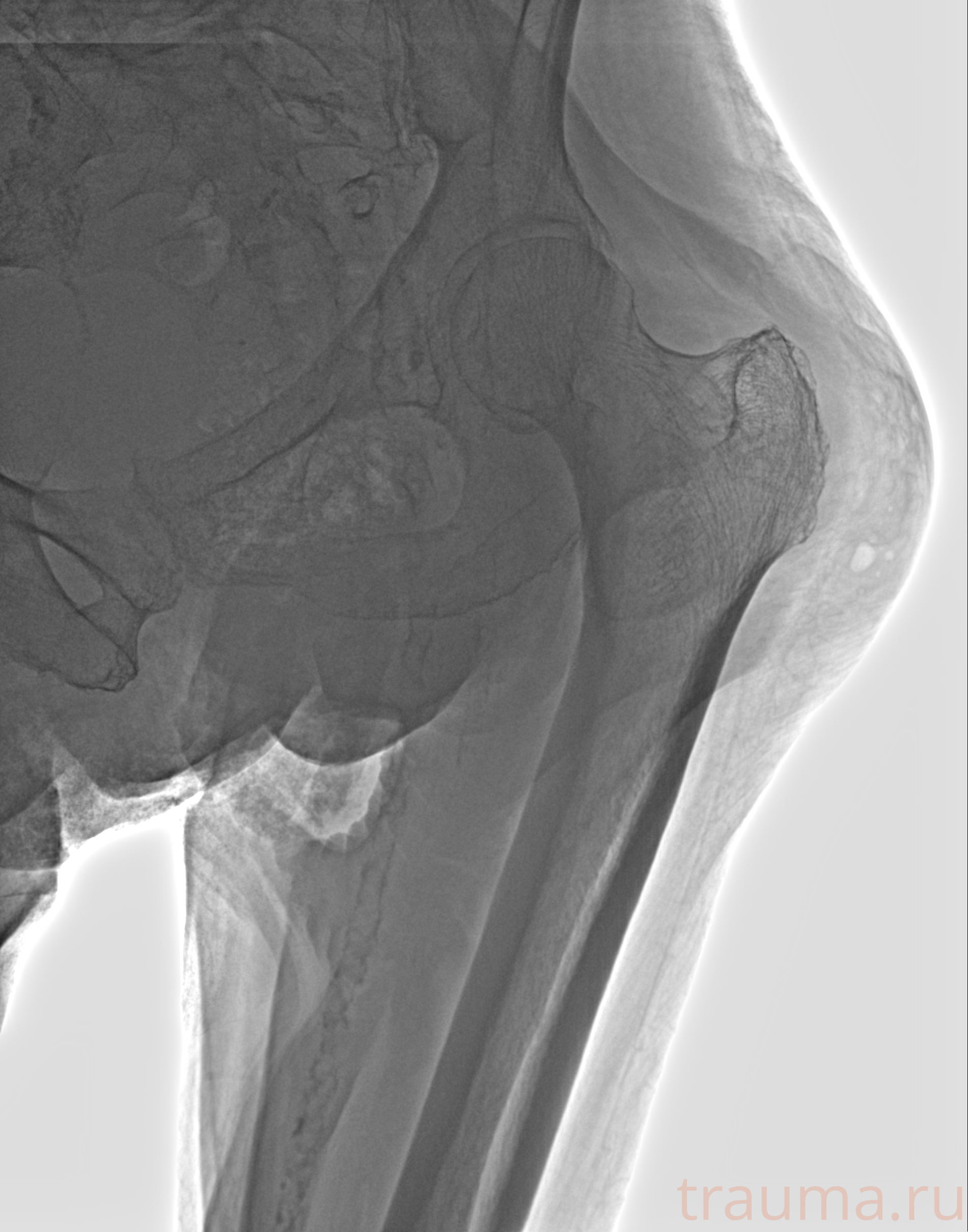 Рентген на дому: по вашему адресу приезжает врач-рентгенолог, травматолог-ортопед с мобильным рентгеновским аппаратом, проводит диагностику травмы или заболевания, делает необходимые рентгенограммы, дает рекомендации по дальнейшему лечению. Получить качественные снимки в домашних условиях возможно благодаря уникальной методике, разработанной МосРентген Центром для института  Склифосовского
