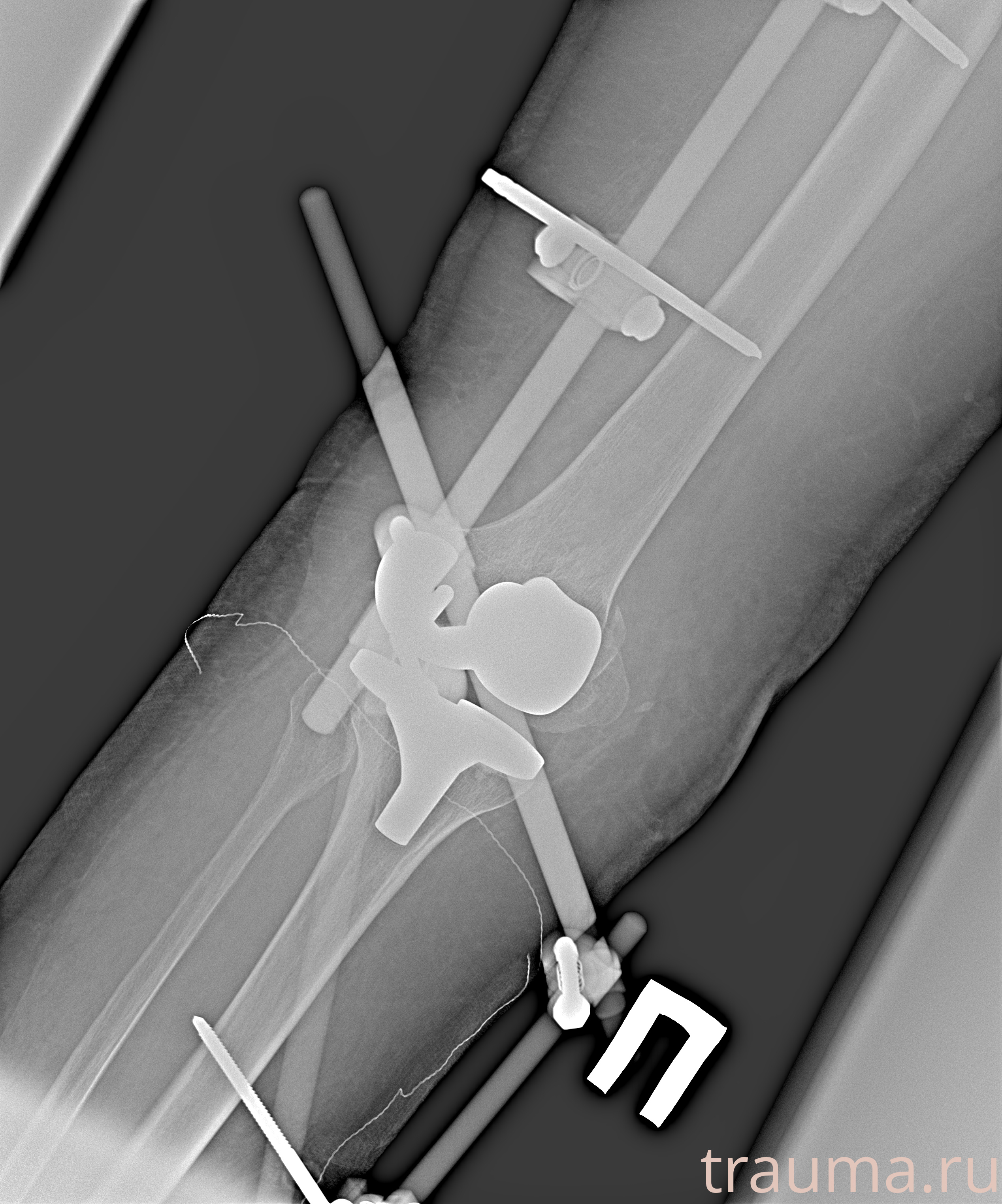 Рентген на дому: по вашему адресу приезжает врач-рентгенолог, травматолог-ортопед с мобильным рентгеновским аппаратом, проводит диагностику травмы или заболевания, делает необходимые рентгенограммы, дает рекомендации по дальнейшему лечению. Получить качественные снимки в домашних условиях возможно благодаря уникальной методике, разработанной МосРентген Центром для института  Склифосовского