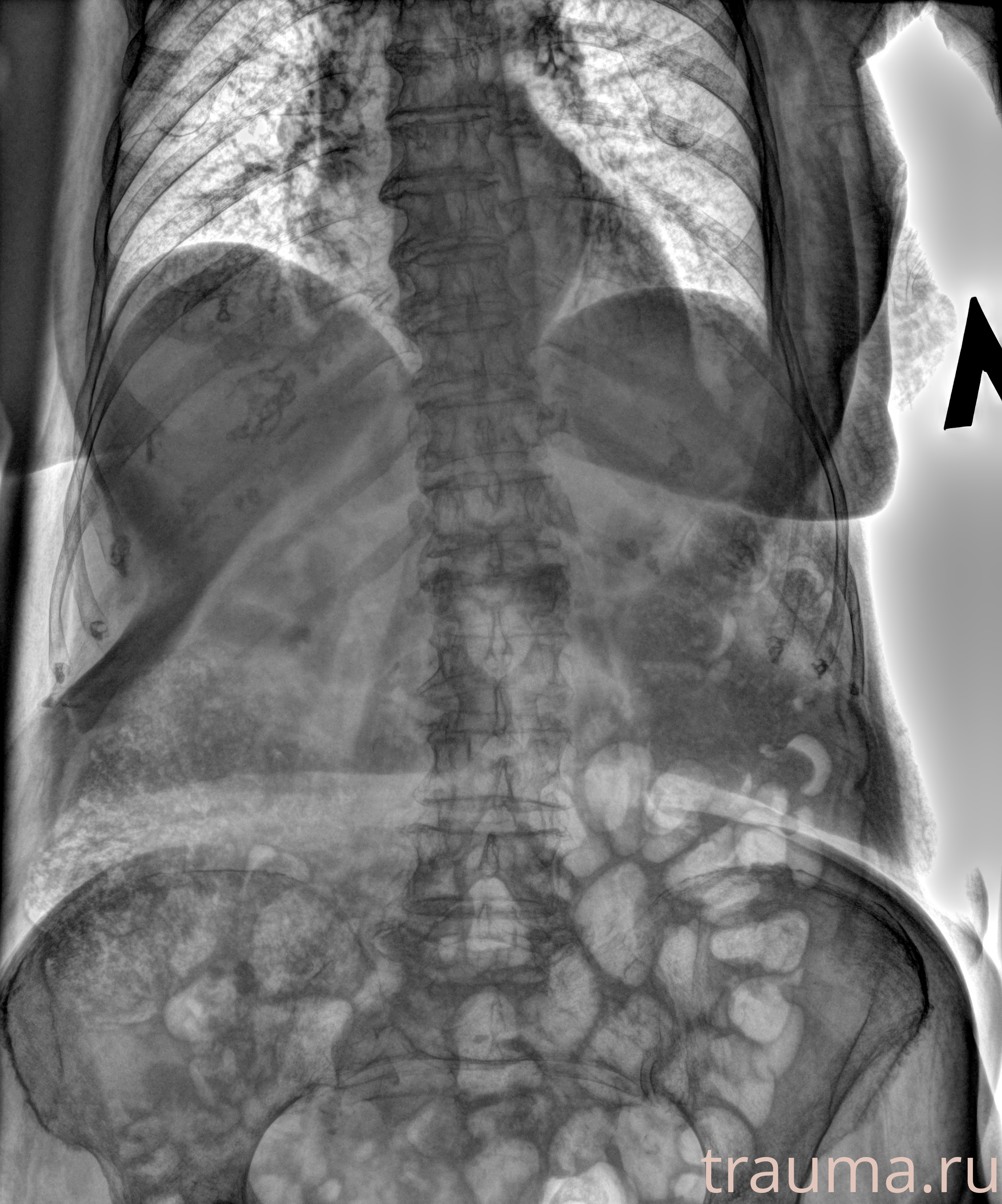 Рентген на дому: по вашему адресу приезжает врач-рентгенолог, травматолог-ортопед с мобильным рентгеновским аппаратом, проводит диагностику травмы или заболевания, делает необходимые рентгенограммы, дает рекомендации по дальнейшему лечению. Получить качественные снимки в домашних условиях возможно благодаря уникальной методике, разработанной МосРентген Центром для института  Склифосовского