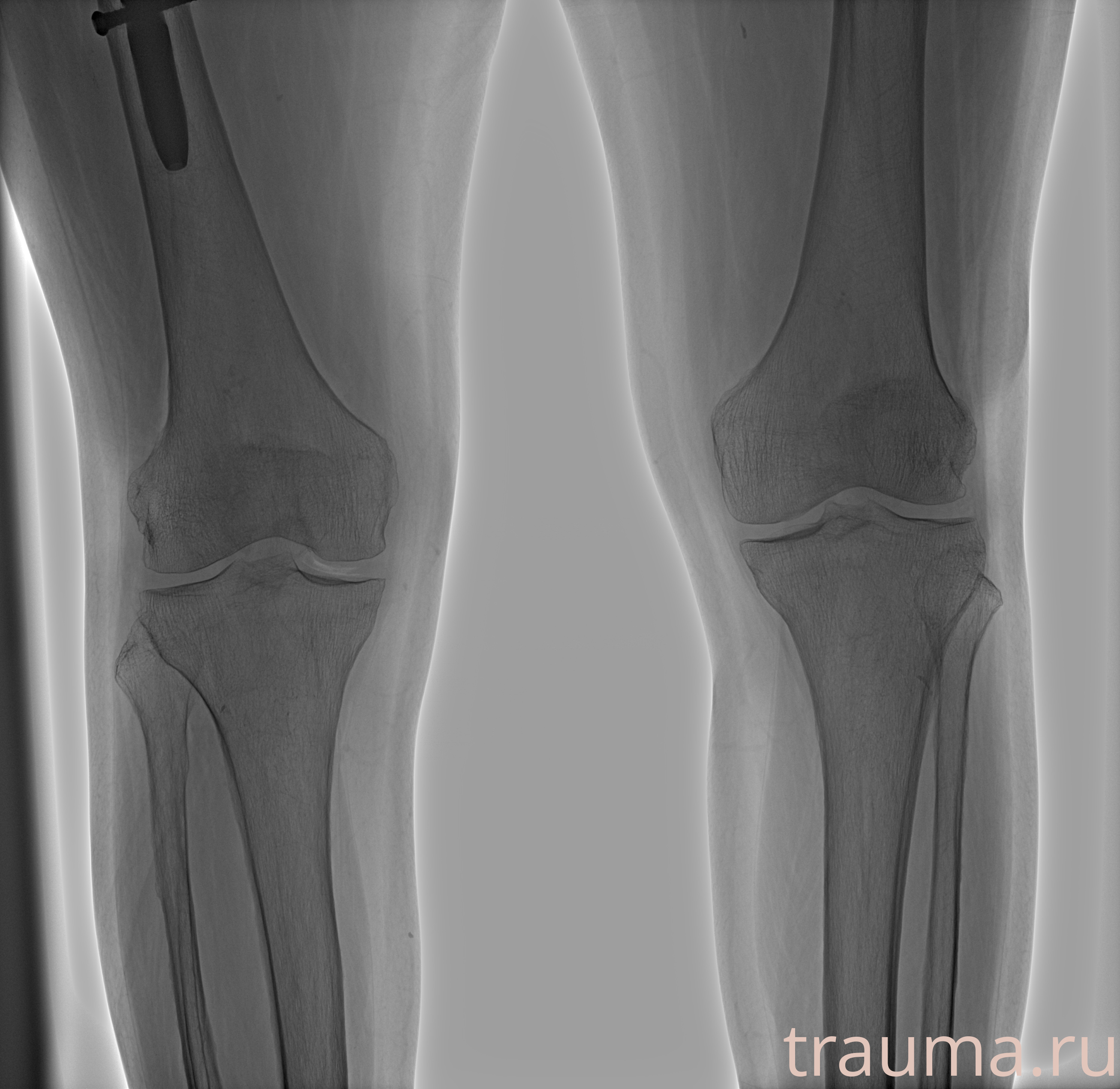 Рентген на дому: по вашему адресу приезжает врач-рентгенолог, травматолог-ортопед с мобильным рентгеновским аппаратом, проводит диагностику травмы или заболевания, делает необходимые рентгенограммы, дает рекомендации по дальнейшему лечению. Получить качественные снимки в домашних условиях возможно благодаря уникальной методике, разработанной МосРентген Центром для института  Склифосовского