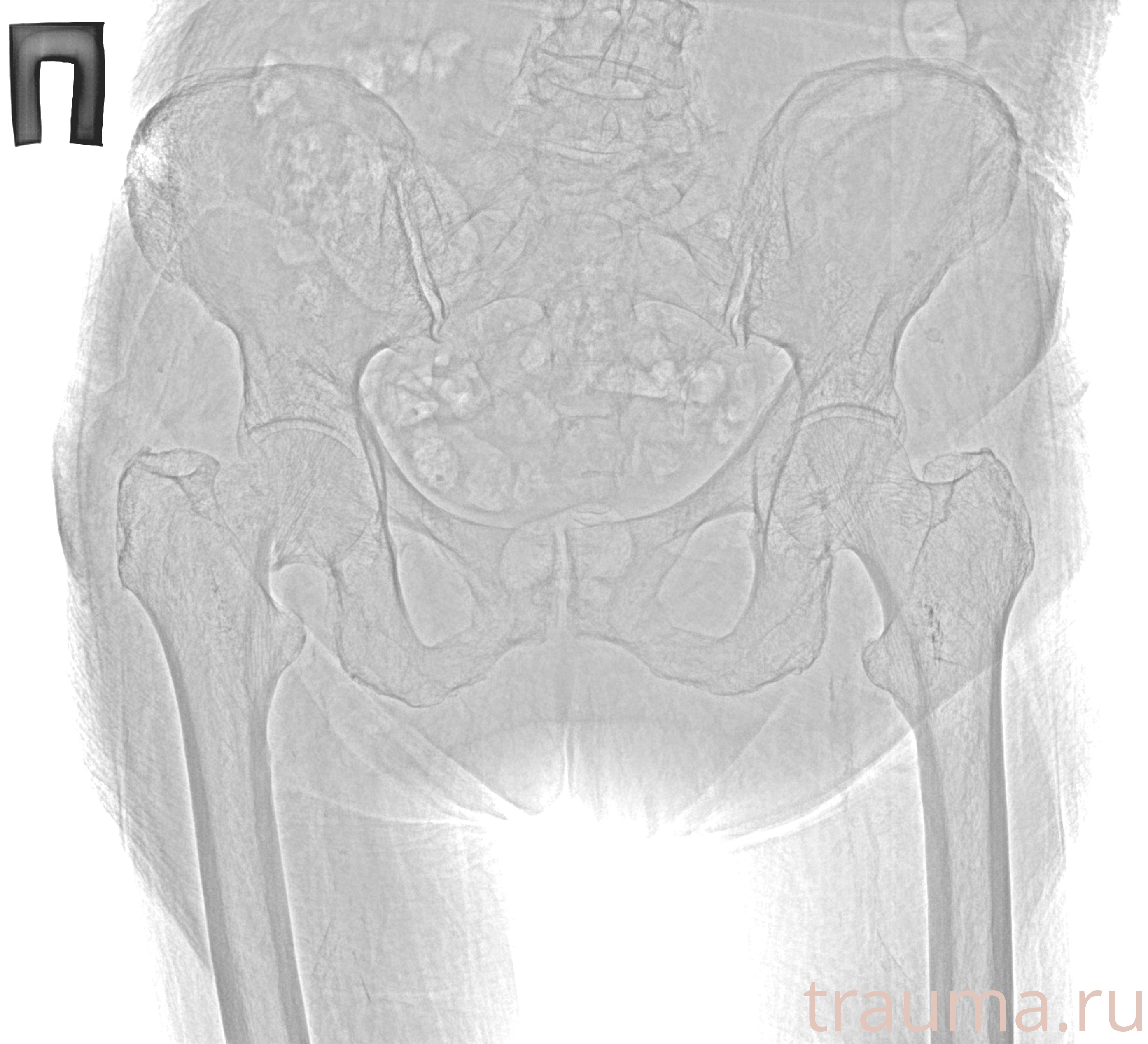 Рентген на дому: по вашему адресу приезжает врач-рентгенолог, травматолог-ортопед с мобильным рентгеновским аппаратом, проводит диагностику травмы или заболевания, делает необходимые рентгенограммы, дает рекомендации по дальнейшему лечению. Получить качественные снимки в домашних условиях возможно благодаря уникальной методике, разработанной МосРентген Центром для института  Склифосовского