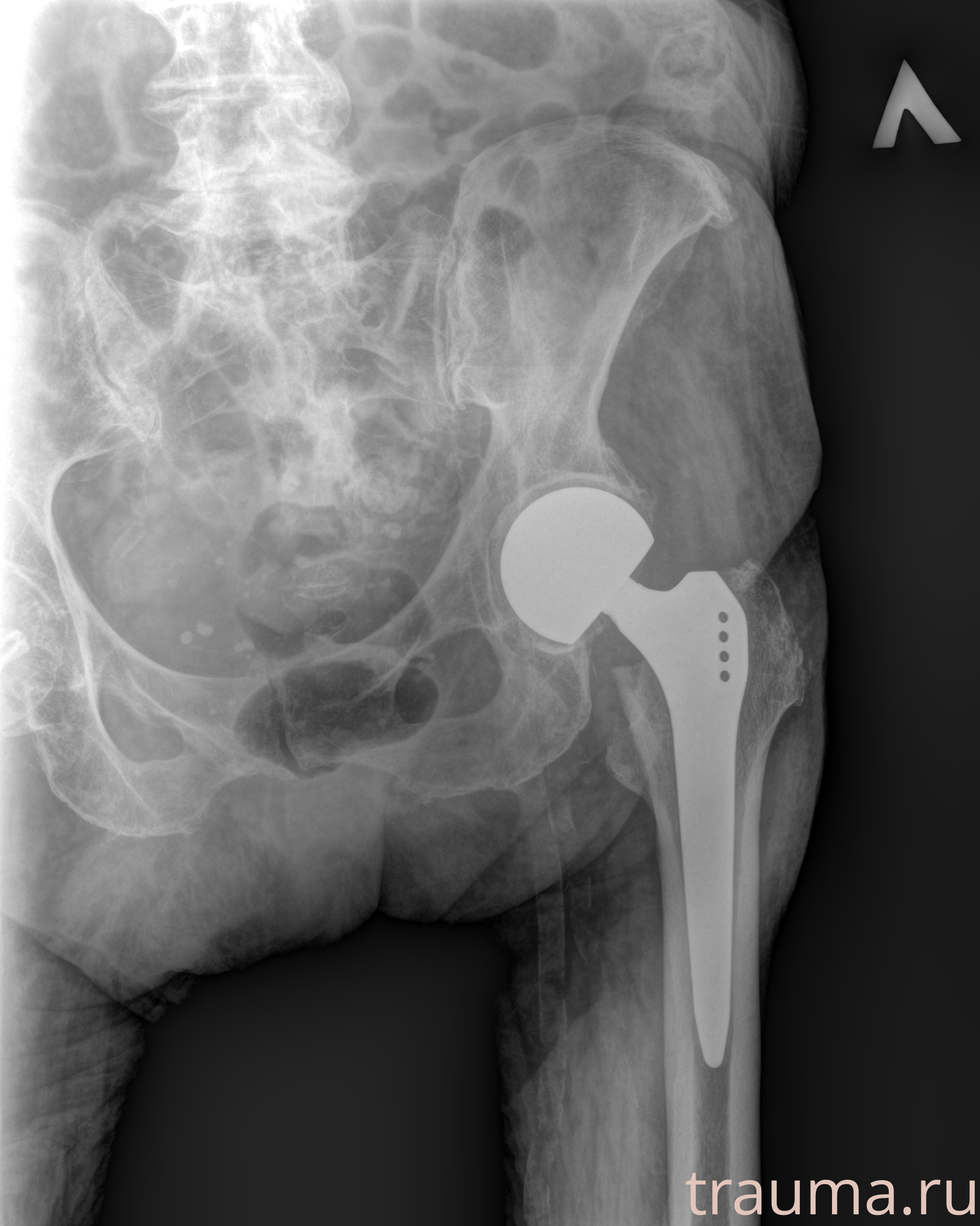 Рентген на дому: по вашему адресу приезжает врач-рентгенолог, травматолог-ортопед с мобильным рентгеновским аппаратом, проводит диагностику травмы или заболевания, делает необходимые рентгенограммы, дает рекомендации по дальнейшему лечению. Получить качественные снимки в домашних условиях возможно благодаря уникальной методике, разработанной МосРентген Центром для института  Склифосовского