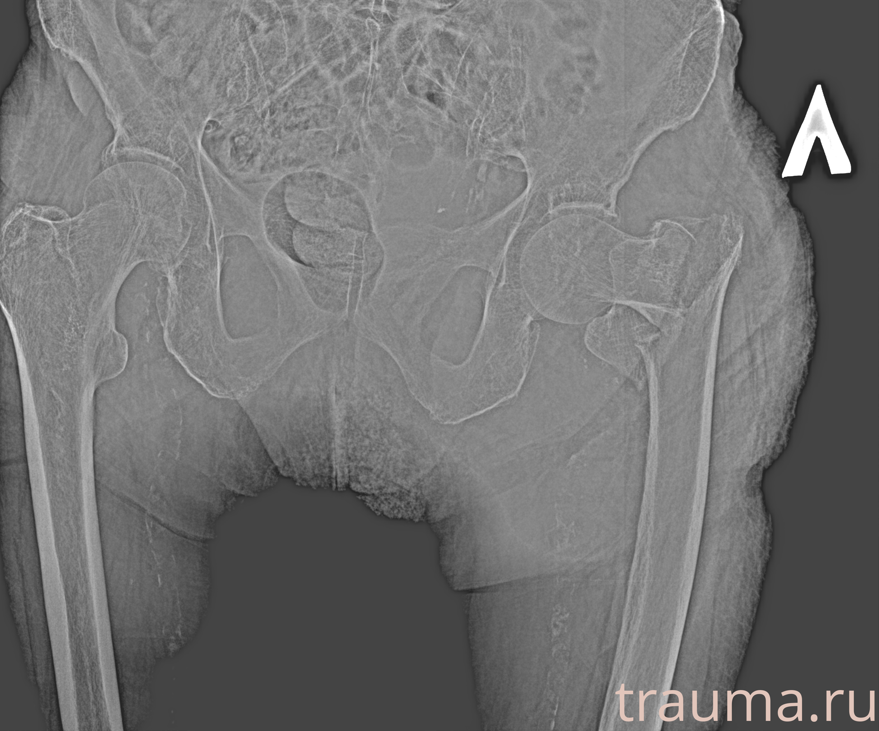 Рентген на дому: по вашему адресу приезжает врач-рентгенолог, травматолог-ортопед с мобильным рентгеновским аппаратом, проводит диагностику травмы или заболевания, делает необходимые рентгенограммы, дает рекомендации по дальнейшему лечению. Получить качественные снимки в домашних условиях возможно благодаря уникальной методике, разработанной МосРентген Центром для института  Склифосовского