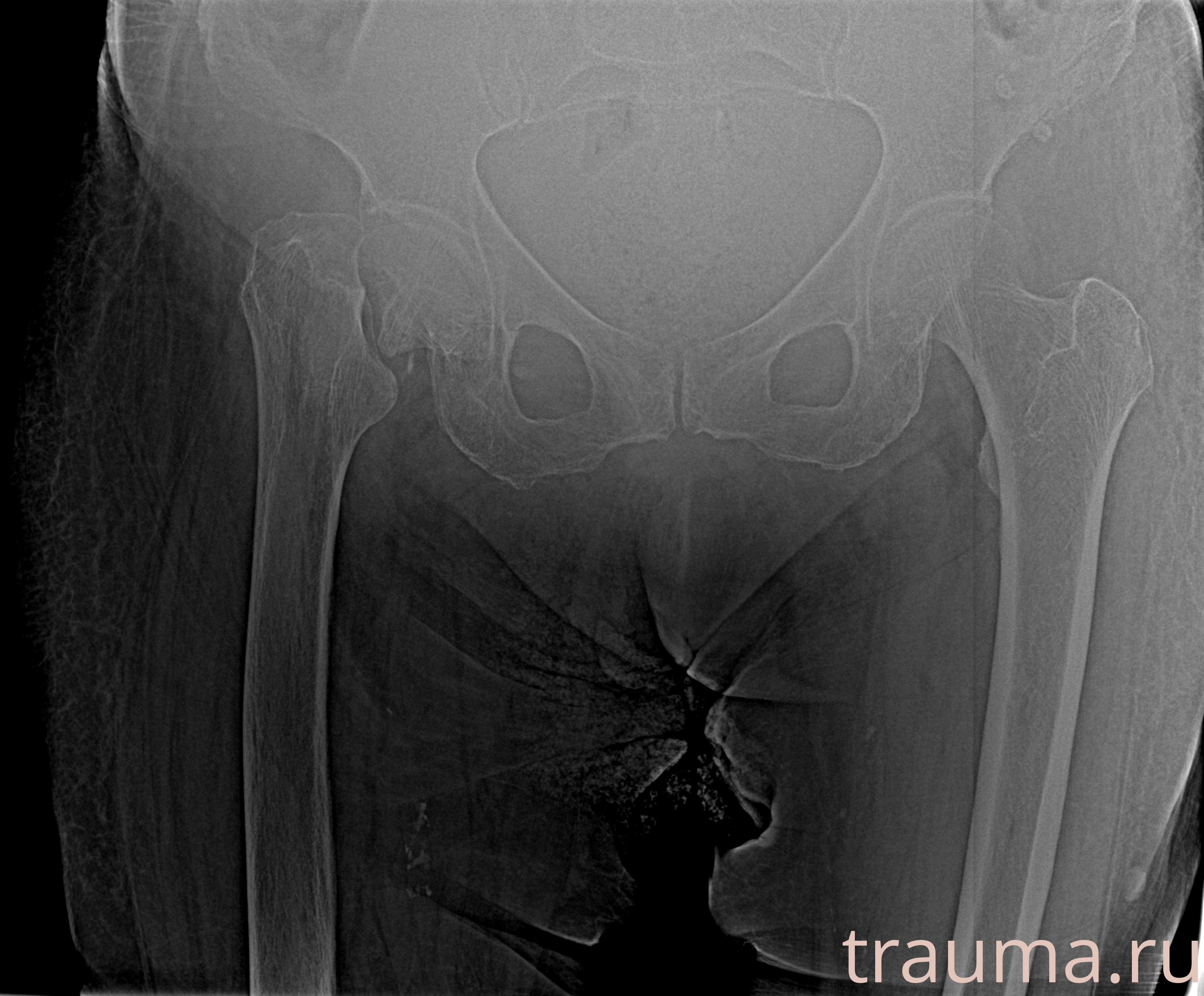 Рентген на дому: по вашему адресу приезжает врач-рентгенолог, травматолог-ортопед с мобильным рентгеновским аппаратом, проводит диагностику травмы или заболевания, делает необходимые рентгенограммы, дает рекомендации по дальнейшему лечению. Получить качественные снимки в домашних условиях возможно благодаря уникальной методике, разработанной МосРентген Центром для института  Склифосовского