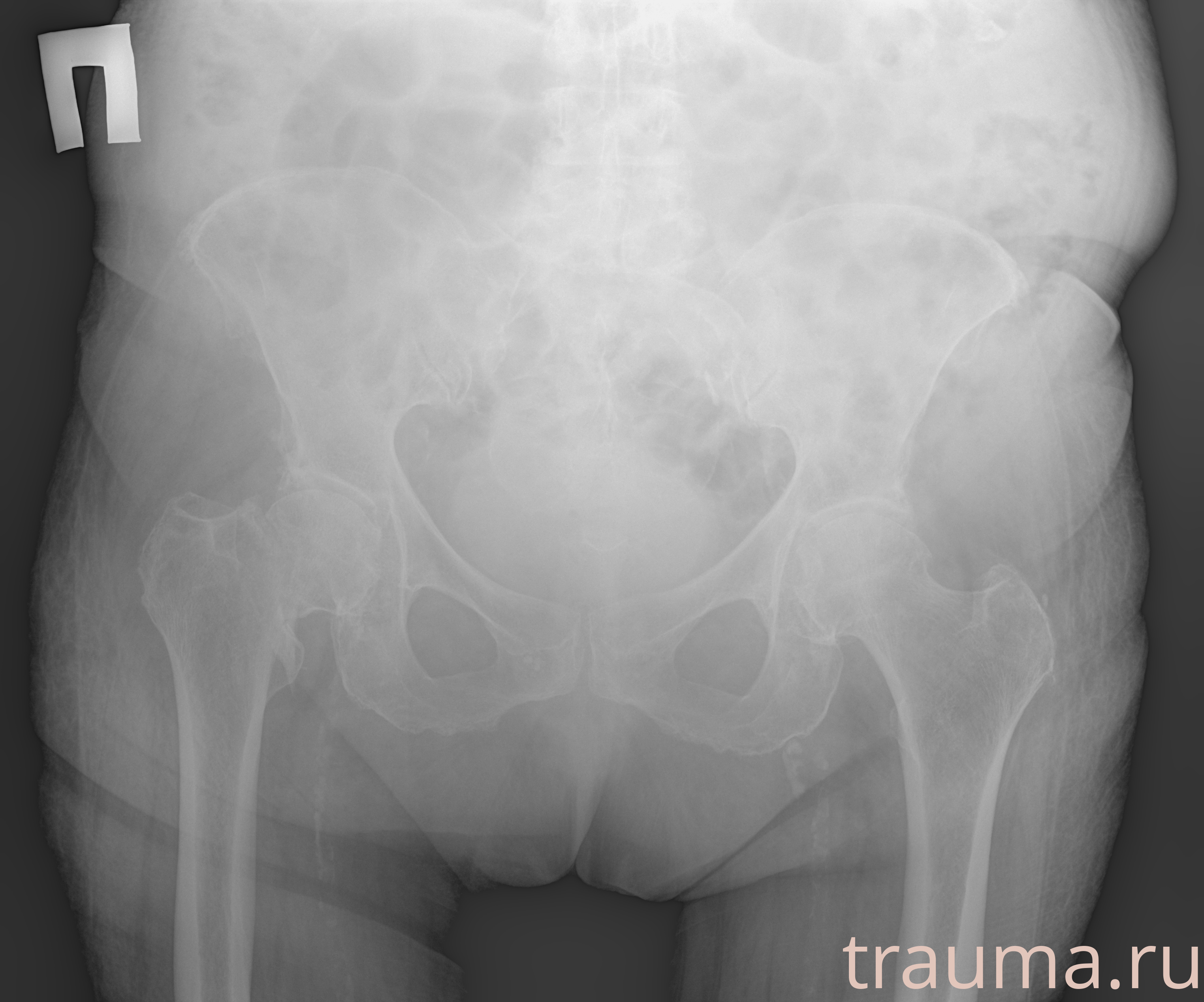 Рентген на дому: по вашему адресу приезжает врач-рентгенолог, травматолог-ортопед с мобильным рентгеновским аппаратом, проводит диагностику травмы или заболевания, делает необходимые рентгенограммы, дает рекомендации по дальнейшему лечению. Получить качественные снимки в домашних условиях возможно благодаря уникальной методике, разработанной МосРентген Центром для института  Склифосовского