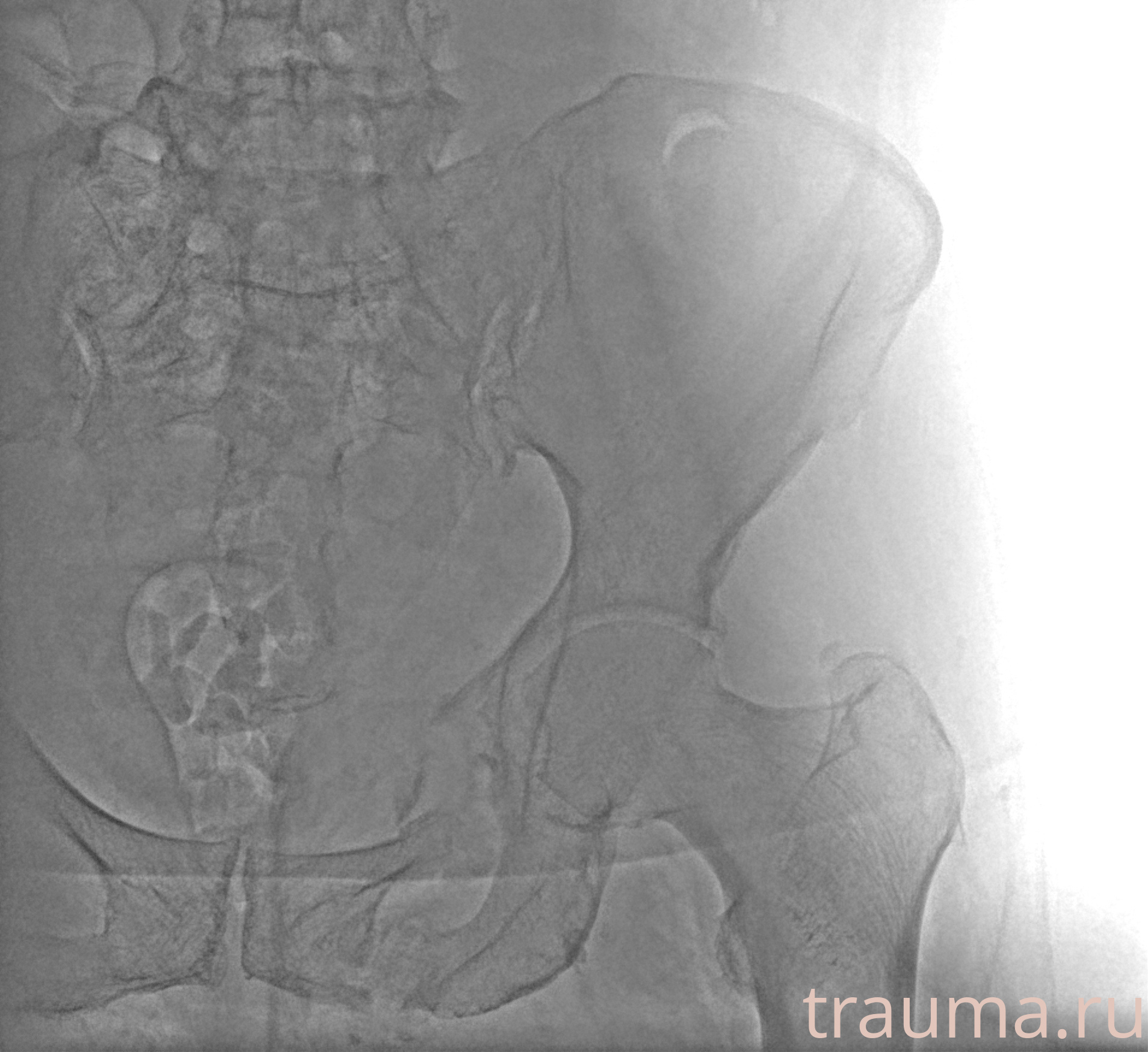 Рентген на дому: по вашему адресу приезжает врач-рентгенолог, травматолог-ортопед с мобильным рентгеновским аппаратом, проводит диагностику травмы или заболевания, делает необходимые рентгенограммы, дает рекомендации по дальнейшему лечению. Получить качественные снимки в домашних условиях возможно благодаря уникальной методике, разработанной МосРентген Центром для института  Склифосовского