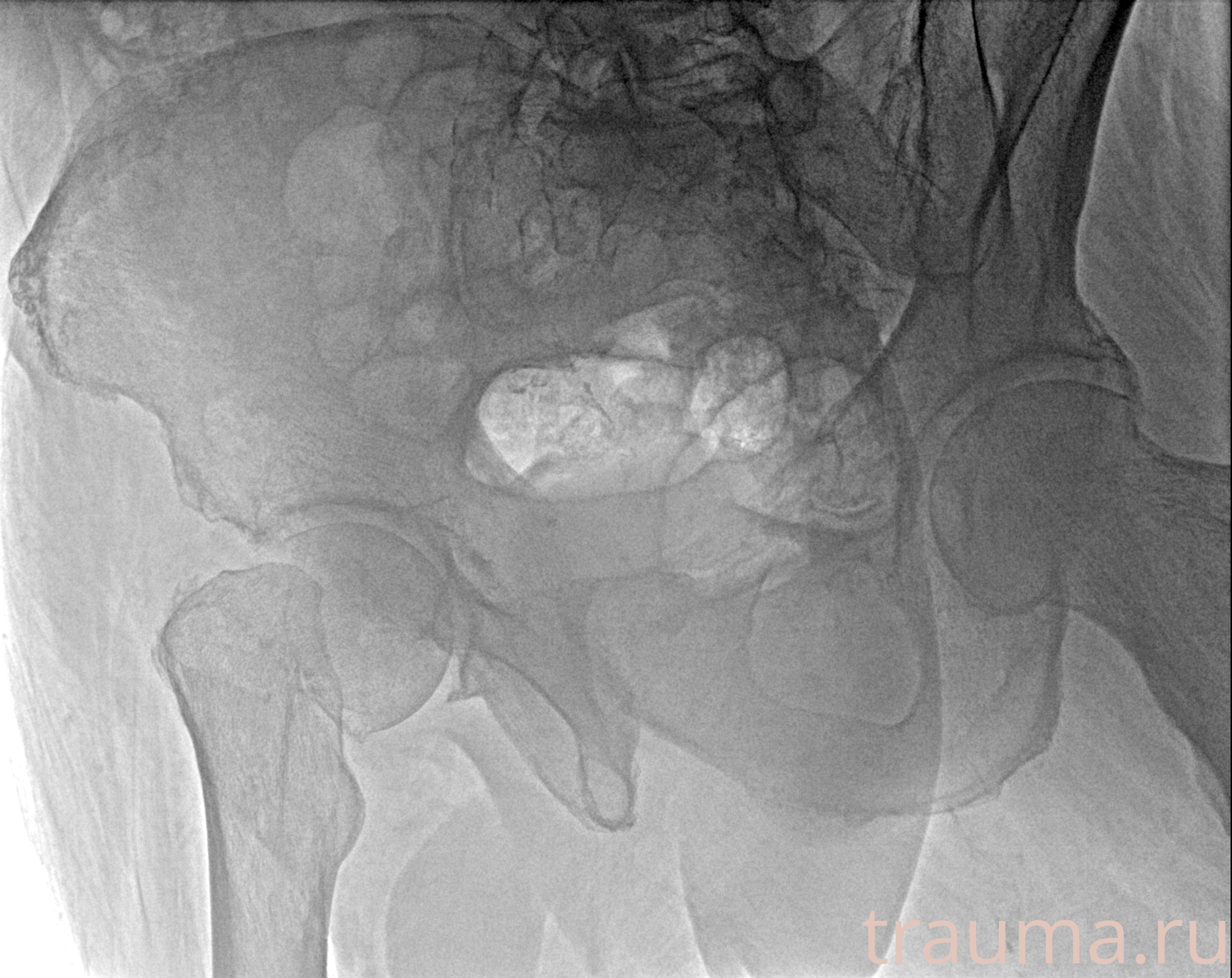 Рентген на дому: по вашему адресу приезжает врач-рентгенолог, травматолог-ортопед с мобильным рентгеновским аппаратом, проводит диагностику травмы или заболевания, делает необходимые рентгенограммы, дает рекомендации по дальнейшему лечению. Получить качественные снимки в домашних условиях возможно благодаря уникальной методике, разработанной МосРентген Центром для института  Склифосовского