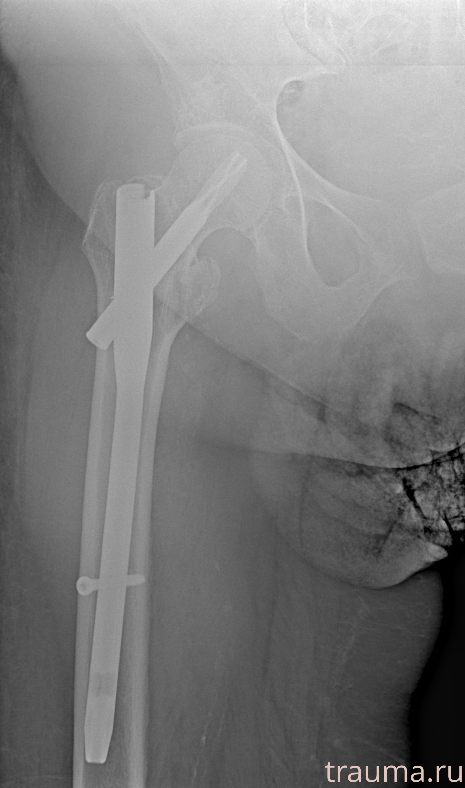 Рентген на дому: по вашему адресу приезжает врач-рентгенолог, травматолог-ортопед с мобильным рентгеновским аппаратом, проводит диагностику травмы или заболевания, делает необходимые рентгенограммы, дает рекомендации по дальнейшему лечению. Получить качественные снимки в домашних условиях возможно благодаря уникальной методике, разработанной МосРентген Центром для института  Склифосовского