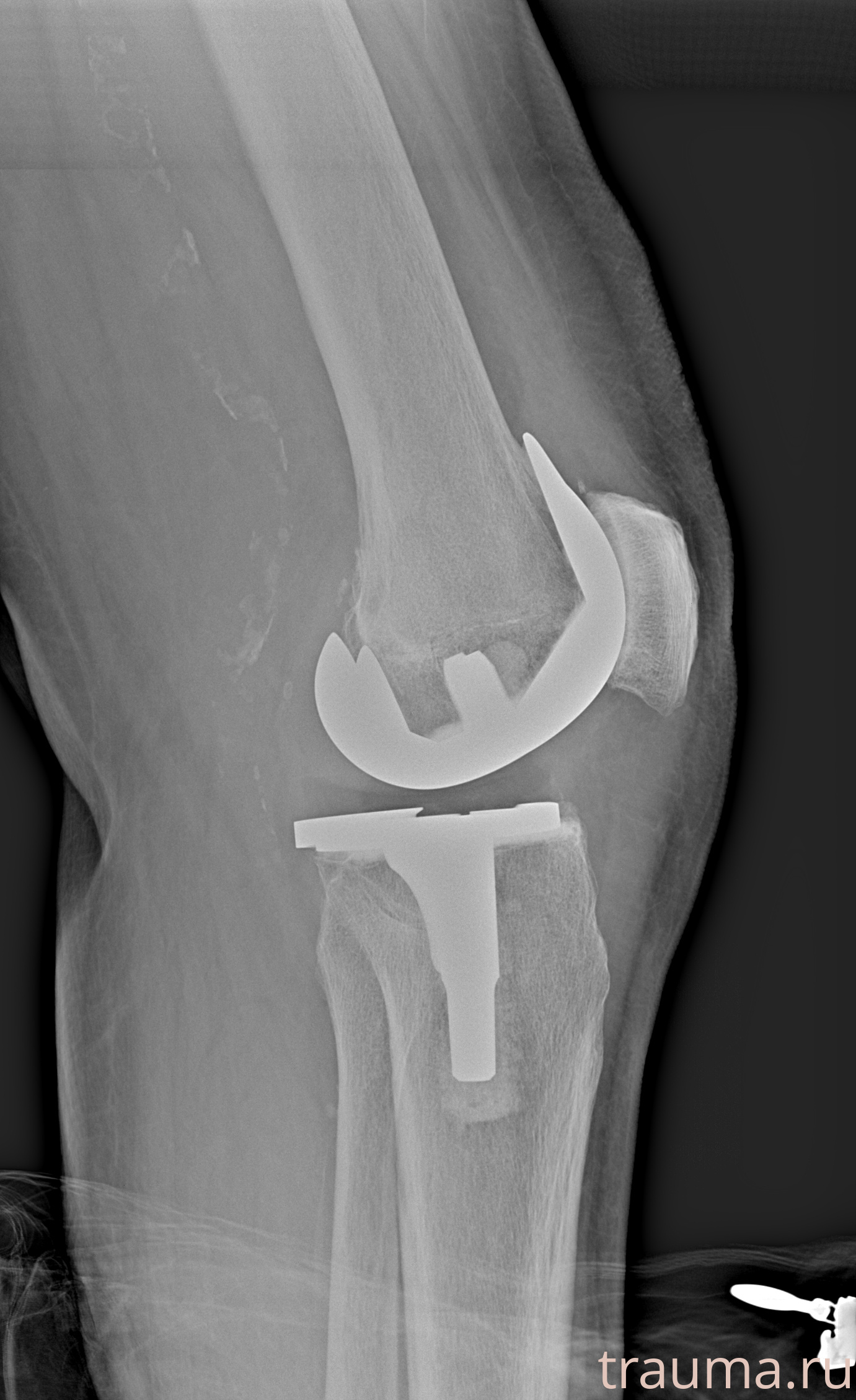 Рентген на дому: по вашему адресу приезжает врач-рентгенолог, травматолог-ортопед с мобильным рентгеновским аппаратом, проводит диагностику травмы или заболевания, делает необходимые рентгенограммы, дает рекомендации по дальнейшему лечению. Получить качественные снимки в домашних условиях возможно благодаря уникальной методике, разработанной МосРентген Центром для института  Склифосовского