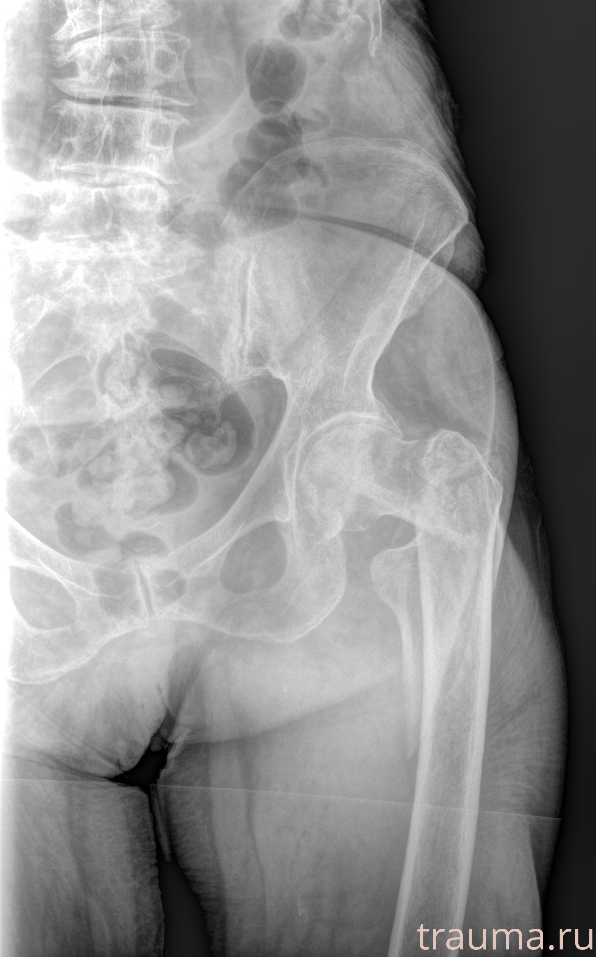 Рентген на дому: по вашему адресу приезжает врач-рентгенолог, травматолог-ортопед с мобильным рентгеновским аппаратом, проводит диагностику травмы или заболевания, делает необходимые рентгенограммы, дает рекомендации по дальнейшему лечению. Получить качественные снимки в домашних условиях возможно благодаря уникальной методике, разработанной МосРентген Центром для института  Склифосовского