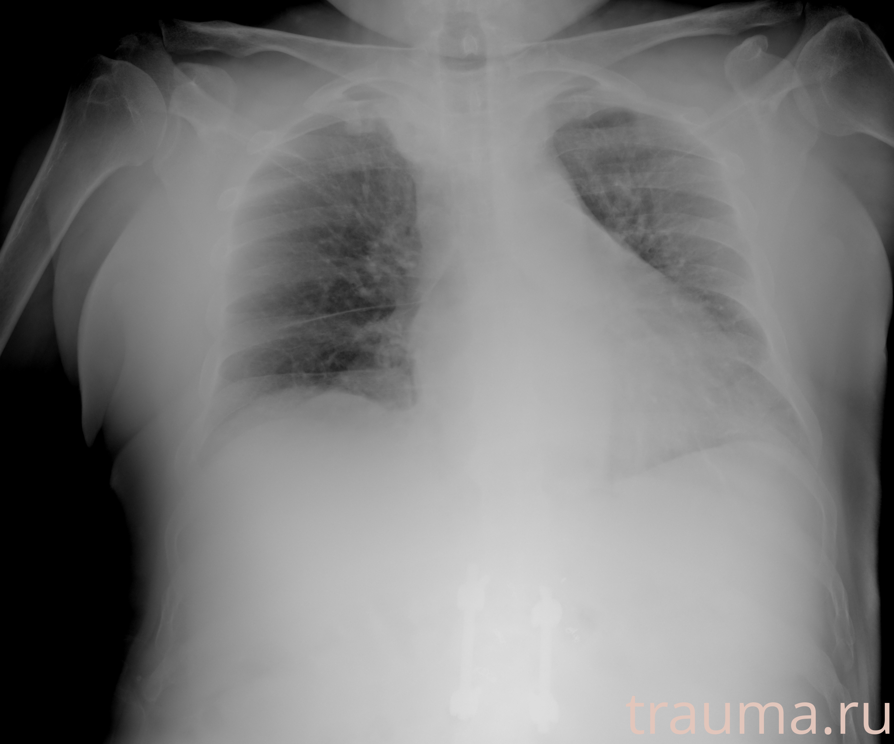 Рентген на дому: по вашему адресу приезжает врач-рентгенолог, травматолог-ортопед с мобильным рентгеновским аппаратом, проводит диагностику травмы или заболевания, делает необходимые рентгенограммы, дает рекомендации по дальнейшему лечению. Получить качественные снимки в домашних условиях возможно благодаря уникальной методике, разработанной МосРентген Центром для института  Склифосовского