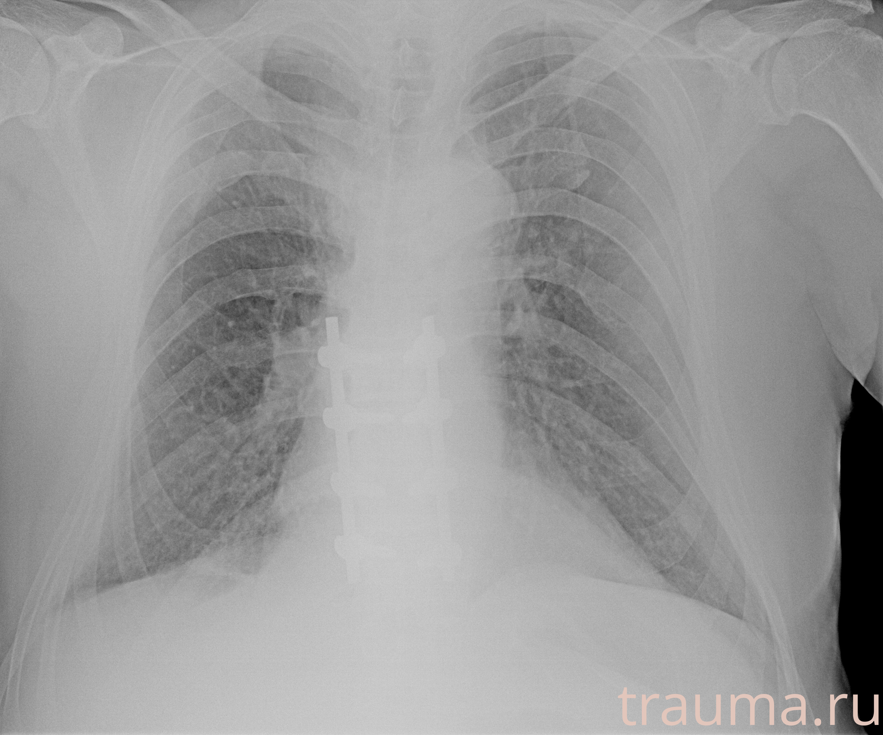 Рентген на дому: по вашему адресу приезжает врач-рентгенолог, травматолог-ортопед с мобильным рентгеновским аппаратом, проводит диагностику травмы или заболевания, делает необходимые рентгенограммы, дает рекомендации по дальнейшему лечению. Получить качественные снимки в домашних условиях возможно благодаря уникальной методике, разработанной МосРентген Центром для института  Склифосовского