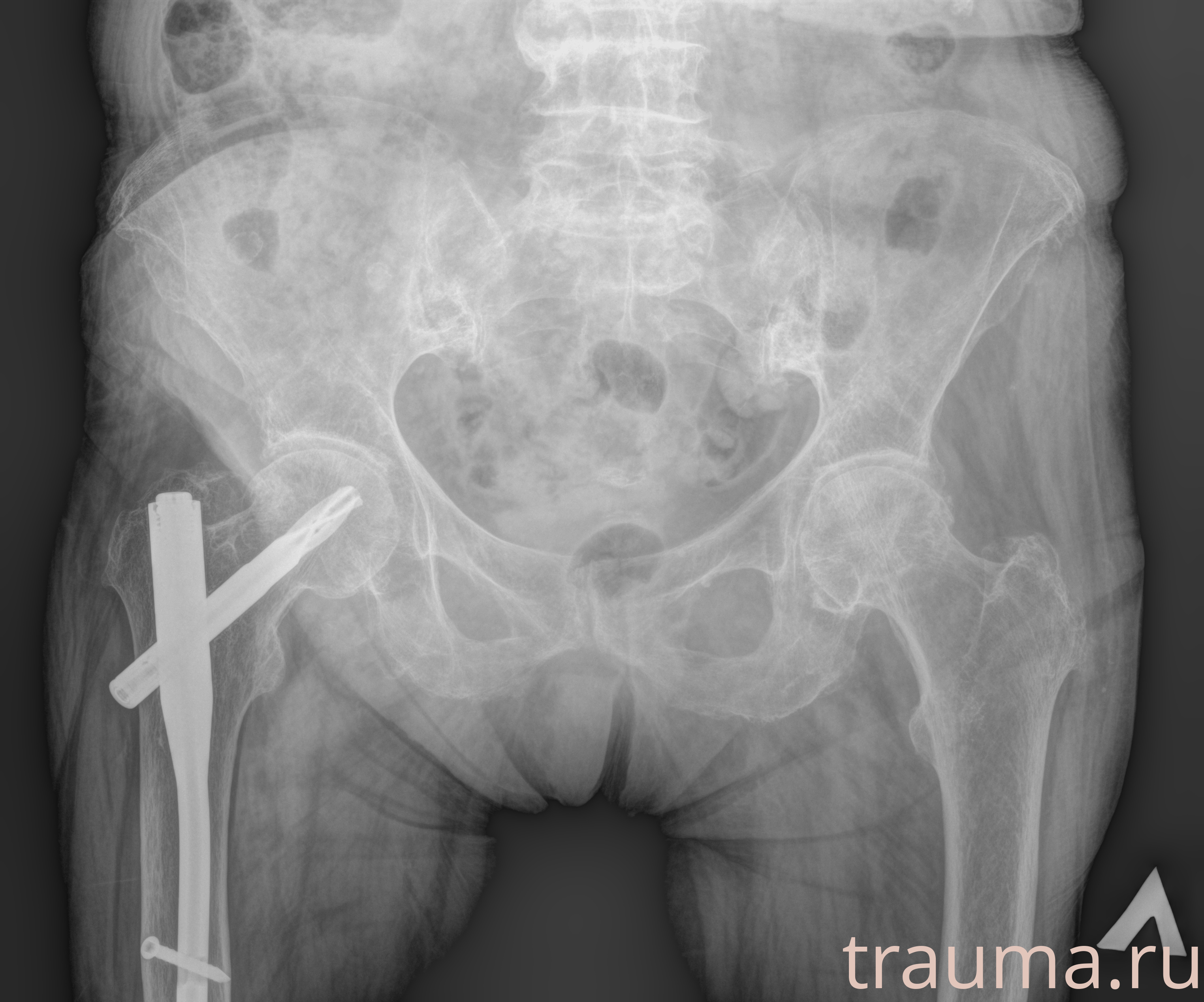 Рентген на дому: по вашему адресу приезжает врач-рентгенолог, травматолог-ортопед с мобильным рентгеновским аппаратом, проводит диагностику травмы или заболевания, делает необходимые рентгенограммы, дает рекомендации по дальнейшему лечению. Получить качественные снимки в домашних условиях возможно благодаря уникальной методике, разработанной МосРентген Центром для института  Склифосовского