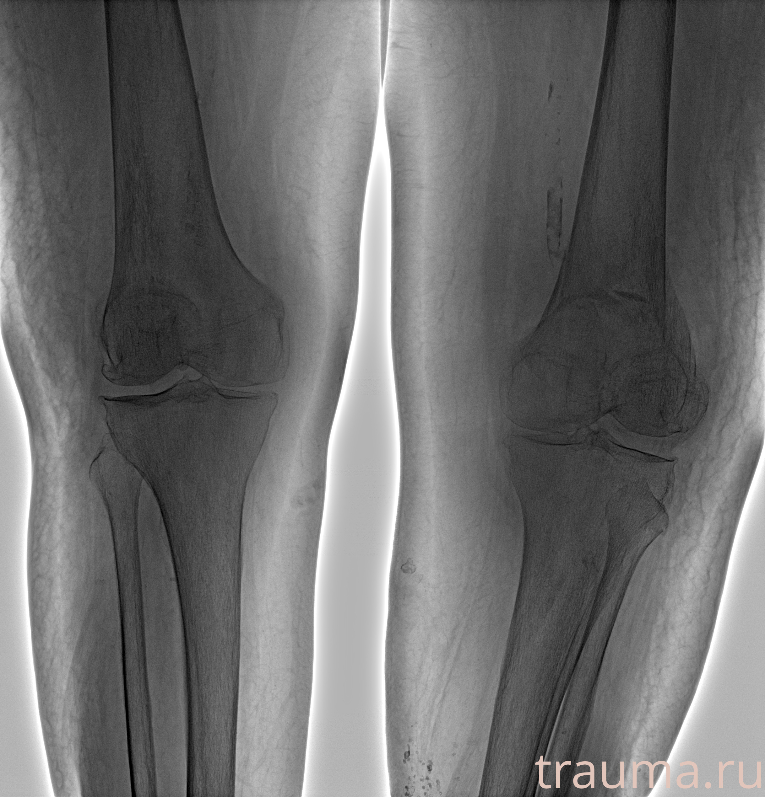 Рентген на дому: по вашему адресу приезжает врач-рентгенолог, травматолог-ортопед с мобильным рентгеновским аппаратом, проводит диагностику травмы или заболевания, делает необходимые рентгенограммы, дает рекомендации по дальнейшему лечению. Получить качественные снимки в домашних условиях возможно благодаря уникальной методике, разработанной МосРентген Центром для института  Склифосовского