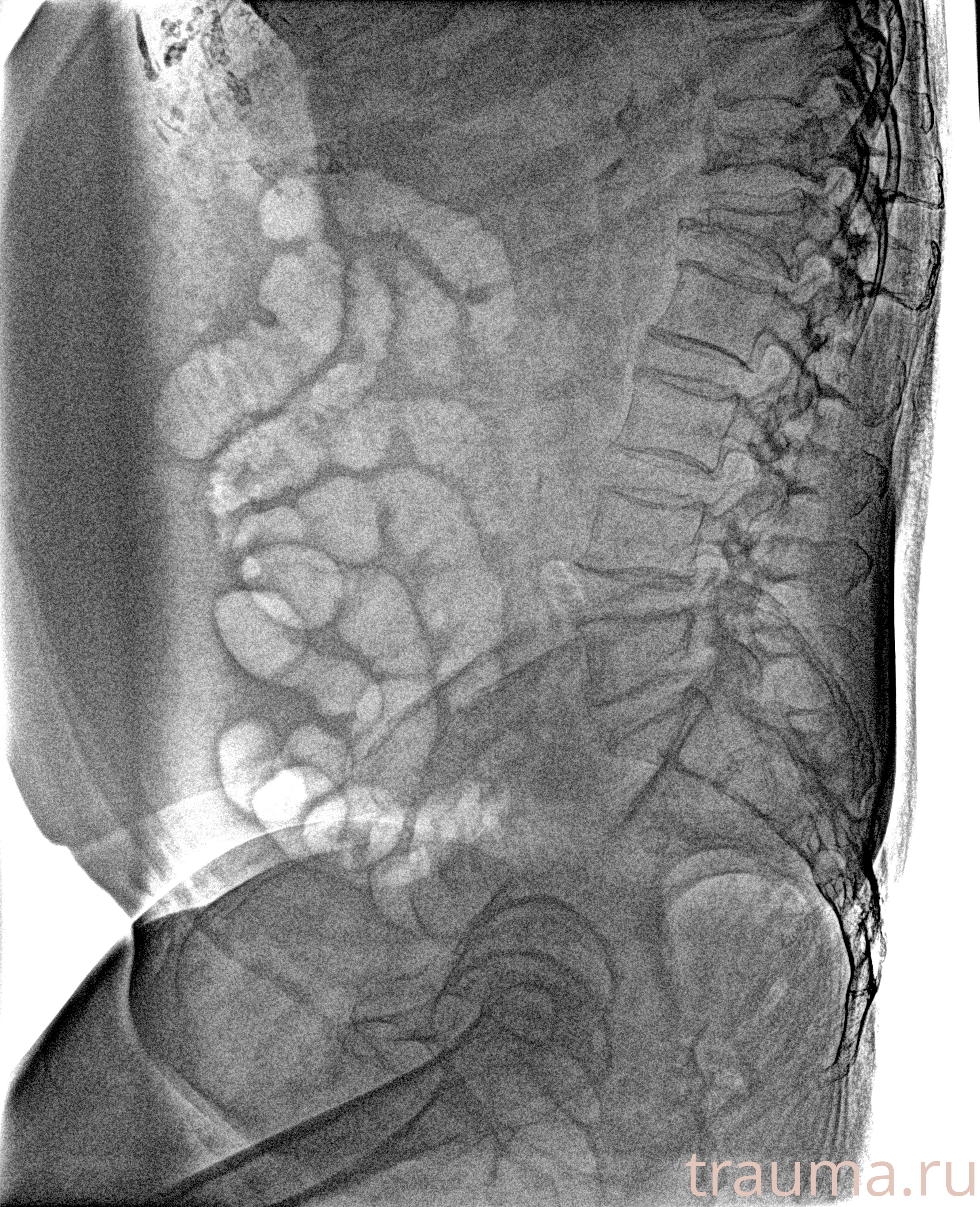 Рентген на дому: по вашему адресу приезжает врач-рентгенолог, травматолог-ортопед с мобильным рентгеновским аппаратом, проводит диагностику травмы или заболевания, делает необходимые рентгенограммы, дает рекомендации по дальнейшему лечению. Получить качественные снимки в домашних условиях возможно благодаря уникальной методике, разработанной МосРентген Центром для института  Склифосовского