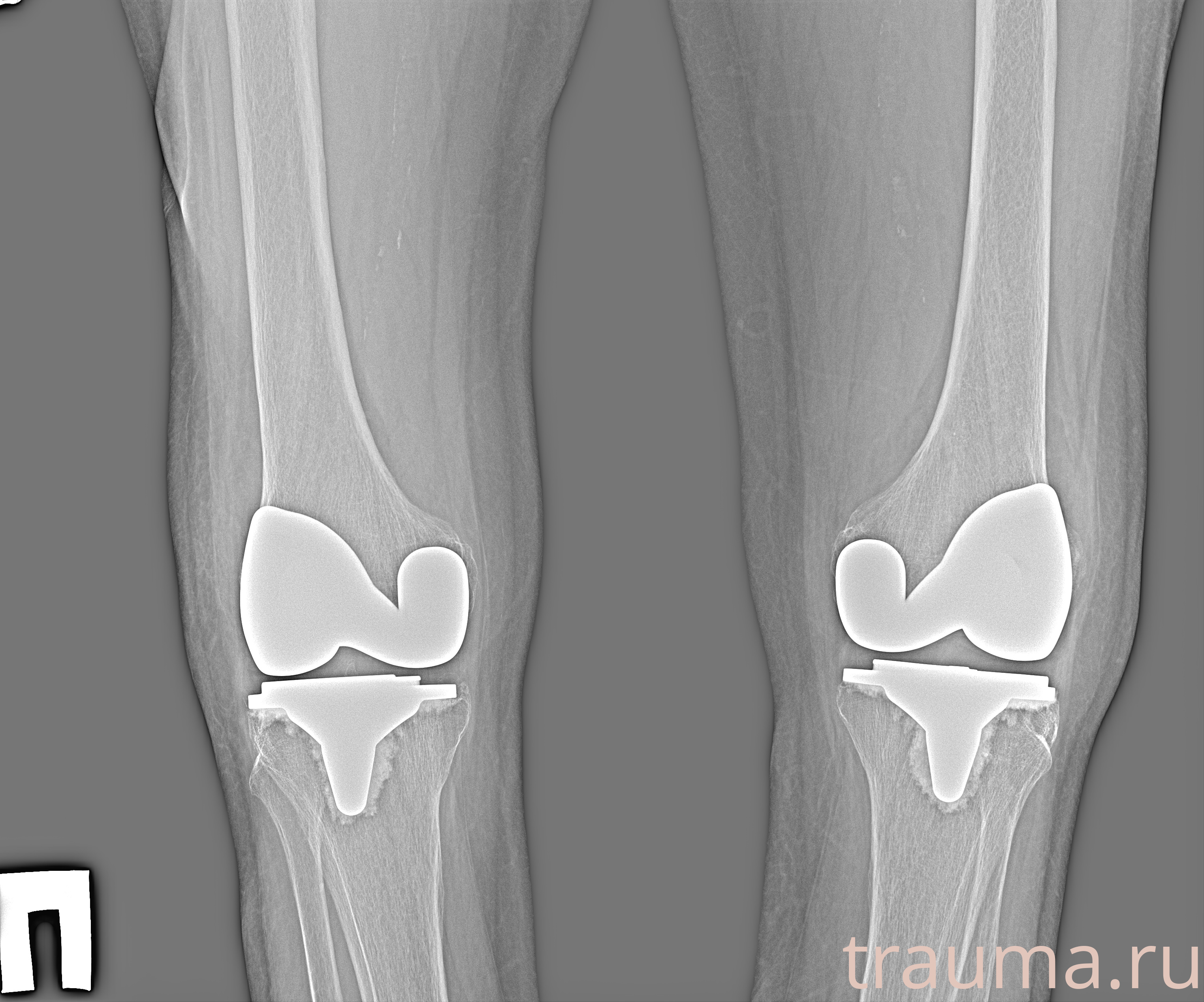 Рентген на дому: по вашему адресу приезжает врач-рентгенолог, травматолог-ортопед с мобильным рентгеновским аппаратом, проводит диагностику травмы или заболевания, делает необходимые рентгенограммы, дает рекомендации по дальнейшему лечению. Получить качественные снимки в домашних условиях возможно благодаря уникальной методике, разработанной МосРентген Центром для института  Склифосовского