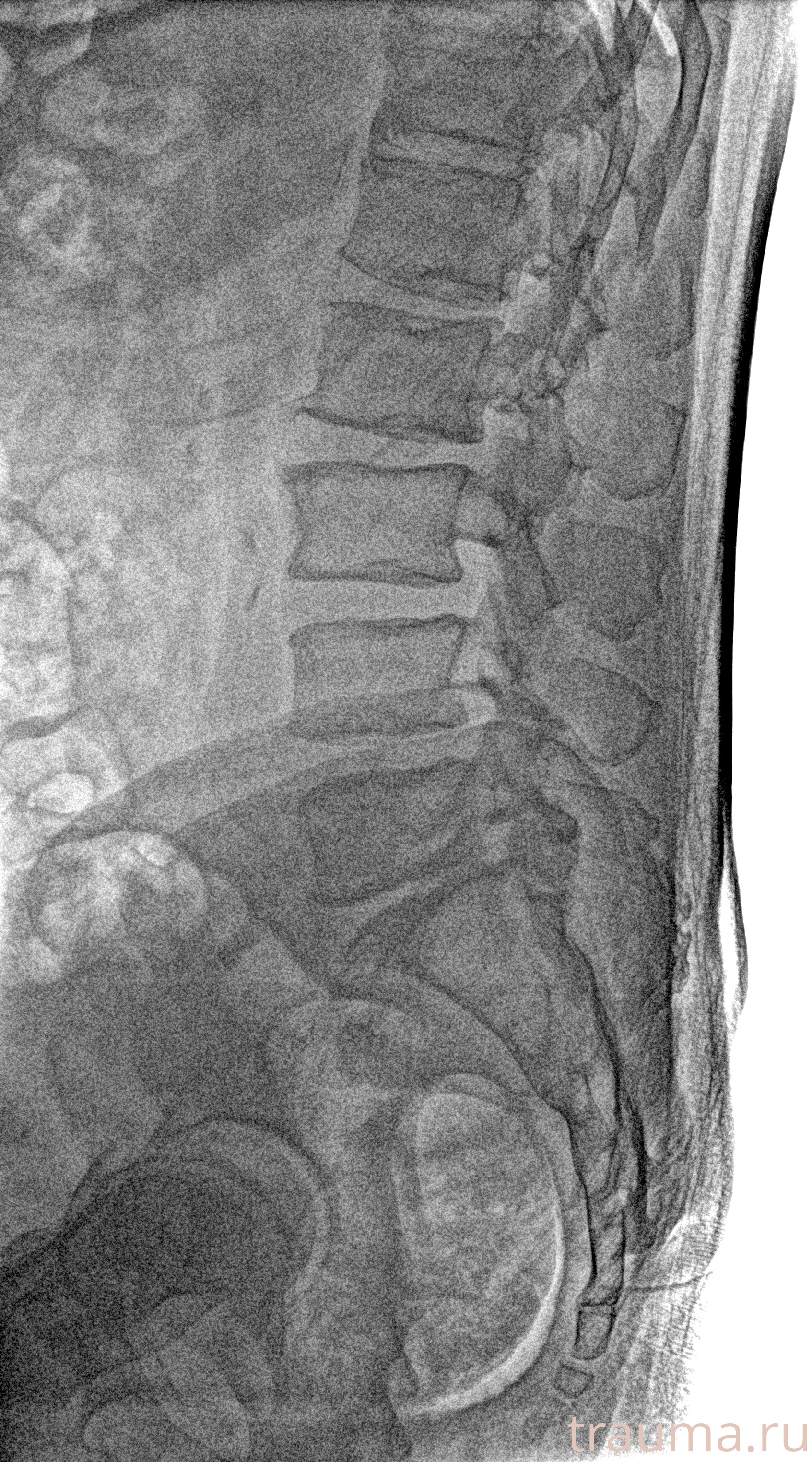 Рентген на дому: по вашему адресу приезжает врач-рентгенолог, травматолог-ортопед с мобильным рентгеновским аппаратом, проводит диагностику травмы или заболевания, делает необходимые рентгенограммы, дает рекомендации по дальнейшему лечению. Получить качественные снимки в домашних условиях возможно благодаря уникальной методике, разработанной МосРентген Центром для института  Склифосовского