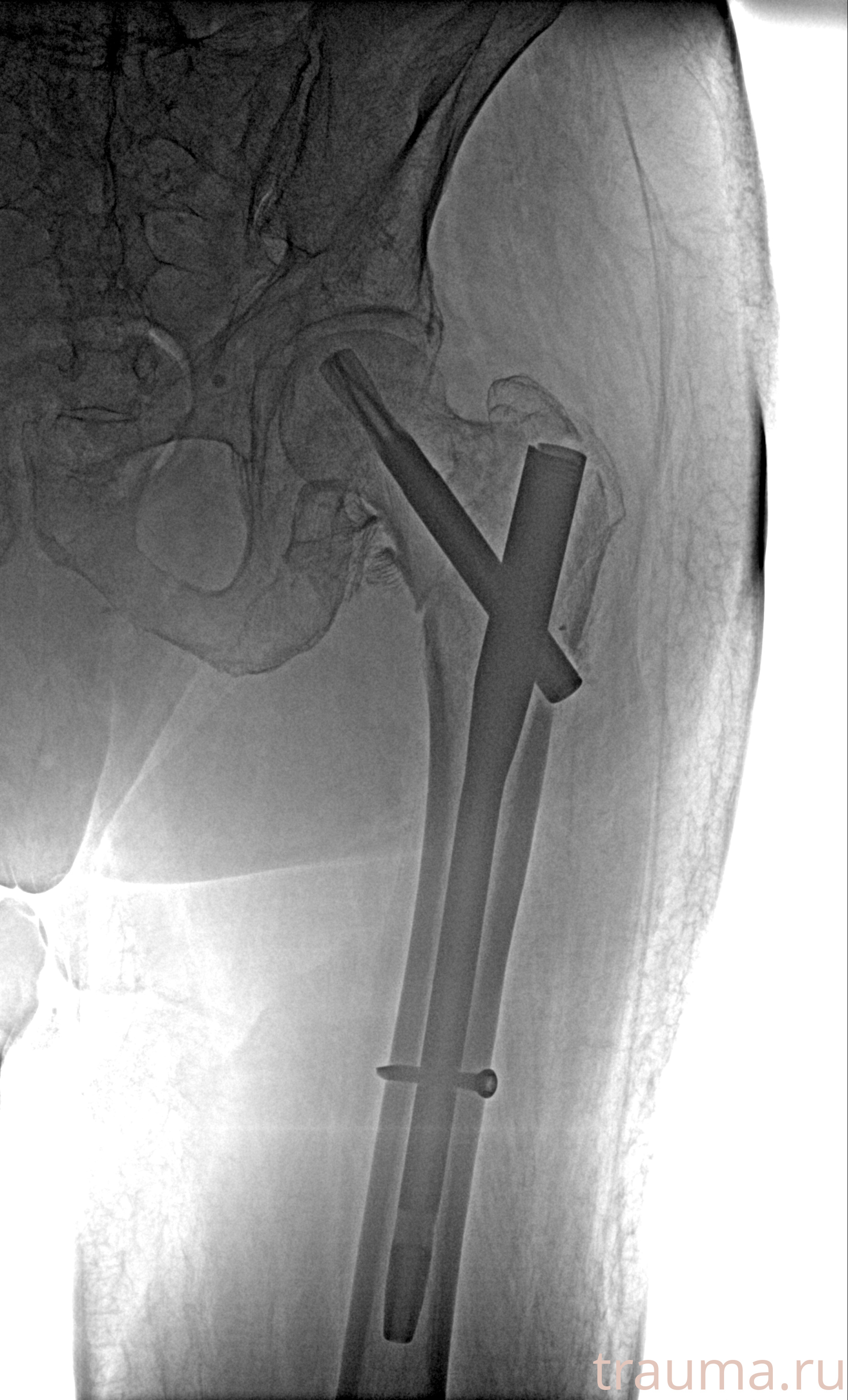 Рентген на дому: по вашему адресу приезжает врач-рентгенолог, травматолог-ортопед с мобильным рентгеновским аппаратом, проводит диагностику травмы или заболевания, делает необходимые рентгенограммы, дает рекомендации по дальнейшему лечению. Получить качественные снимки в домашних условиях возможно благодаря уникальной методике, разработанной МосРентген Центром для института  Склифосовского