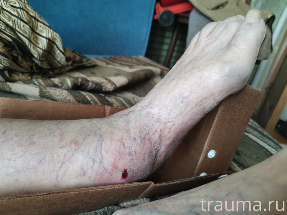 Рентген на дому: по вашему адресу приезжает врач-рентгенолог, травматолог-ортопед с мобильным рентгеновским аппаратом, проводит диагностику травмы или заболевания, делает необходимые рентгенограммы, дает рекомендации по дальнейшему лечению. Получить качественные снимки в домашних условиях возможно благодаря уникальной методике, разработанной МосРентген Центром для института  Склифосовского