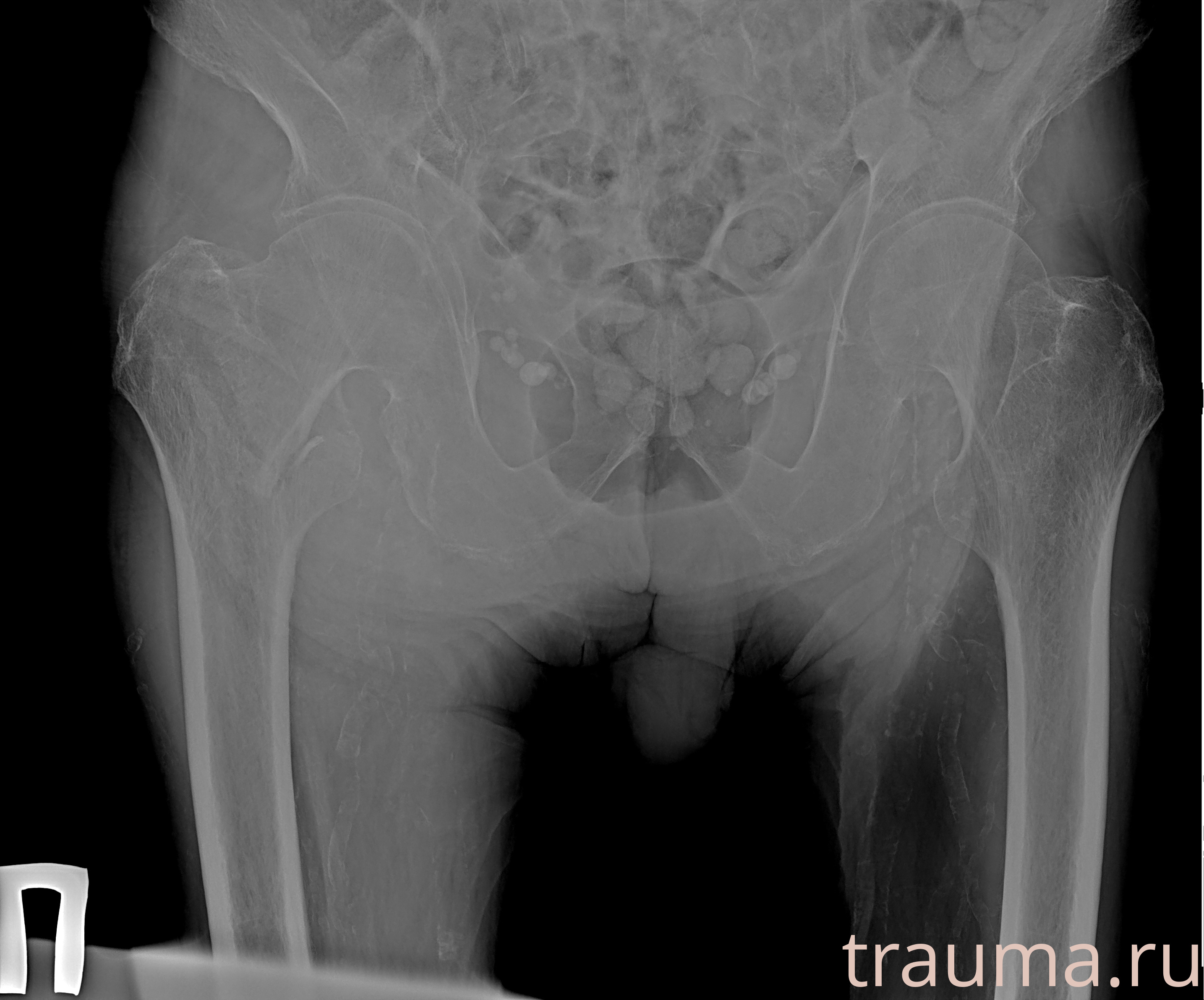 Рентген на дому: по вашему адресу приезжает врач-рентгенолог, травматолог-ортопед с мобильным рентгеновским аппаратом, проводит диагностику травмы или заболевания, делает необходимые рентгенограммы, дает рекомендации по дальнейшему лечению. Получить качественные снимки в домашних условиях возможно благодаря уникальной методике, разработанной МосРентген Центром для института  Склифосовского
