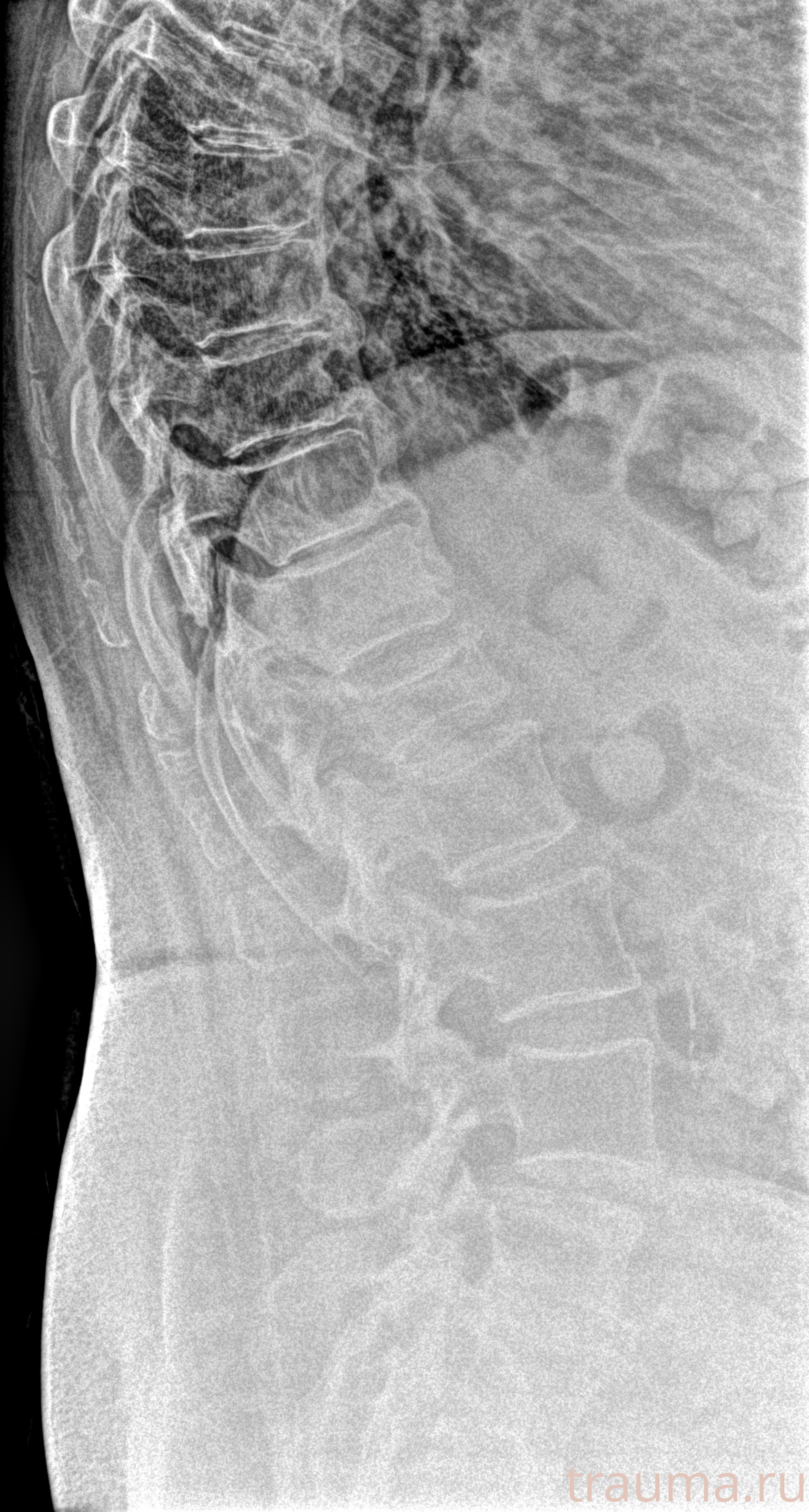 Рентген на дому: по вашему адресу приезжает врач-рентгенолог, травматолог-ортопед с мобильным рентгеновским аппаратом, проводит диагностику травмы или заболевания, делает необходимые рентгенограммы, дает рекомендации по дальнейшему лечению. Получить качественные снимки в домашних условиях возможно благодаря уникальной методике, разработанной МосРентген Центром для института  Склифосовского