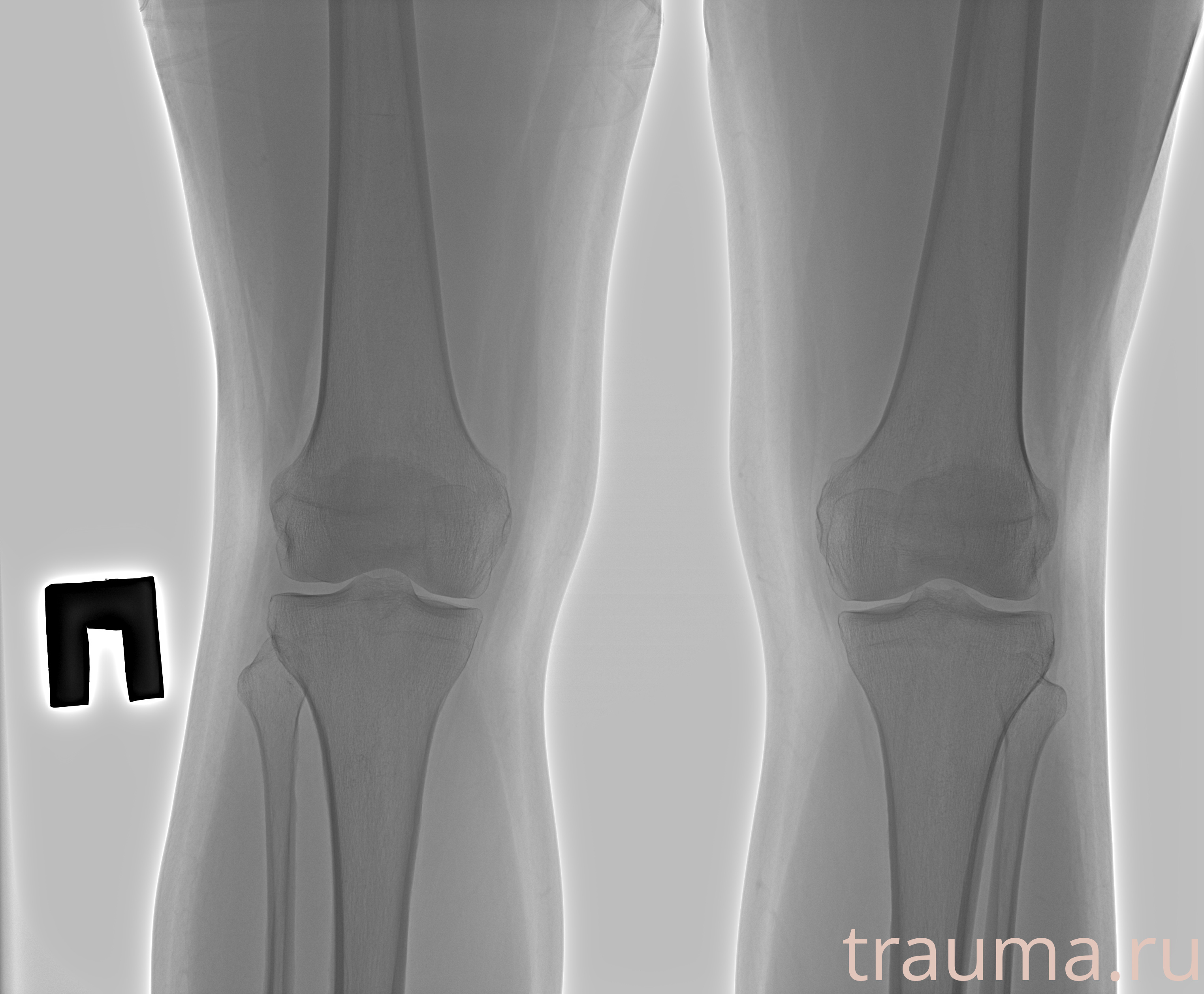 Рентген на дому: по вашему адресу приезжает врач-рентгенолог, травматолог-ортопед с мобильным рентгеновским аппаратом, проводит диагностику травмы или заболевания, делает необходимые рентгенограммы, дает рекомендации по дальнейшему лечению. Получить качественные снимки в домашних условиях возможно благодаря уникальной методике, разработанной МосРентген Центром для института  Склифосовского