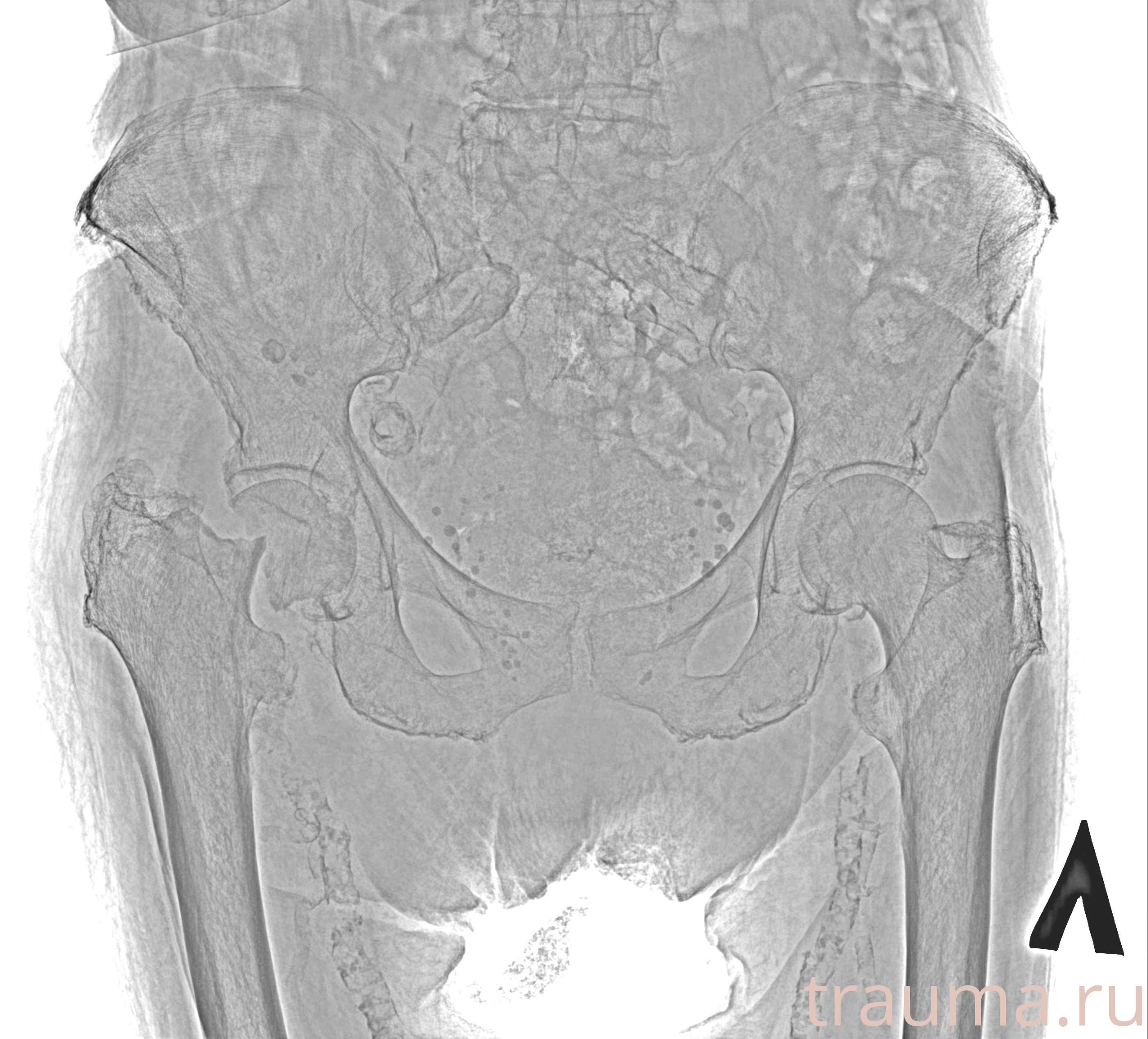 Рентген на дому: по вашему адресу приезжает врач-рентгенолог, травматолог-ортопед с мобильным рентгеновским аппаратом, проводит диагностику травмы или заболевания, делает необходимые рентгенограммы, дает рекомендации по дальнейшему лечению. Получить качественные снимки в домашних условиях возможно благодаря уникальной методике, разработанной МосРентген Центром для института  Склифосовского