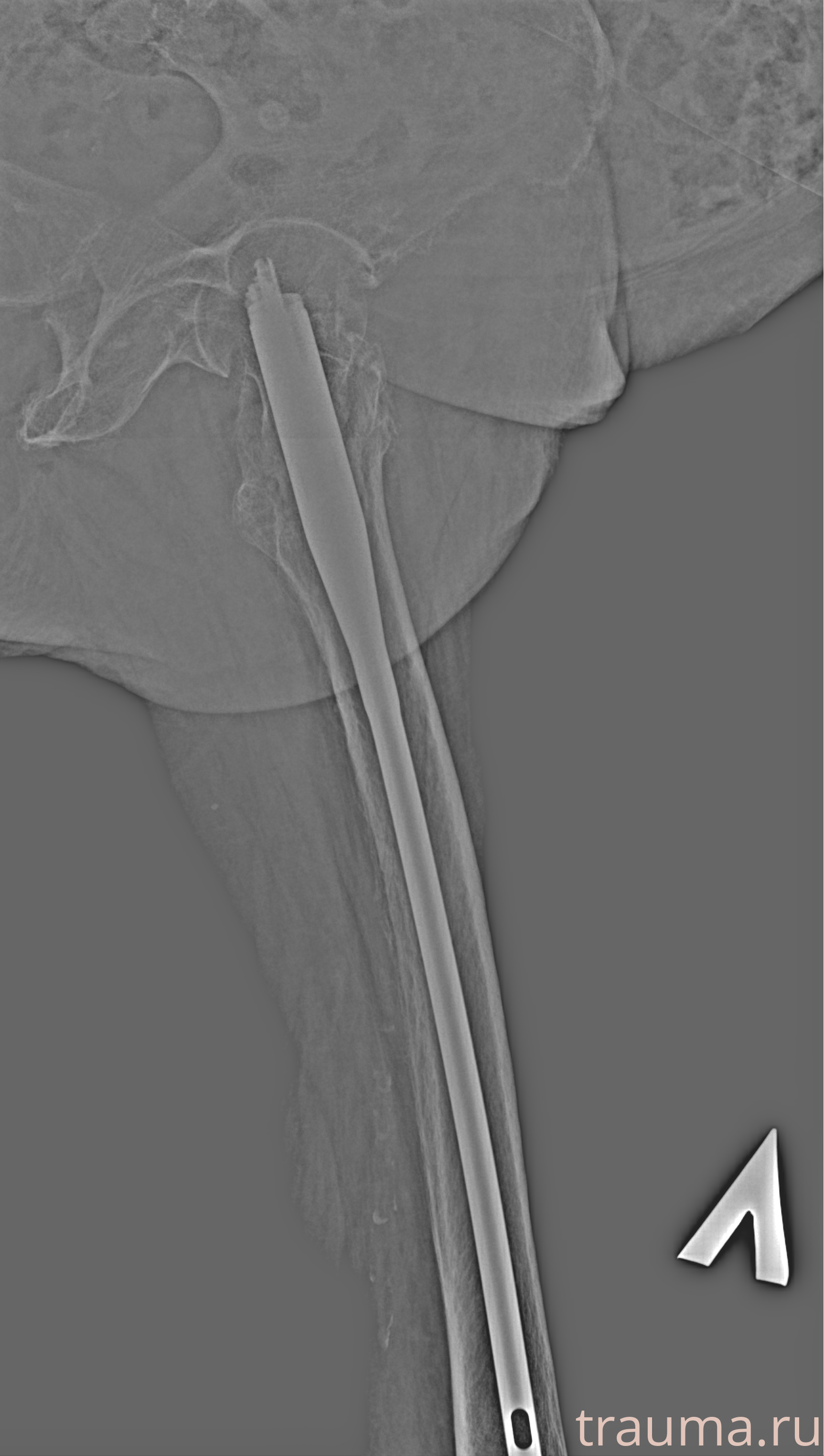 Рентген на дому: по вашему адресу приезжает врач-рентгенолог, травматолог-ортопед с мобильным рентгеновским аппаратом, проводит диагностику травмы или заболевания, делает необходимые рентгенограммы, дает рекомендации по дальнейшему лечению. Получить качественные снимки в домашних условиях возможно благодаря уникальной методике, разработанной МосРентген Центром для института  Склифосовского