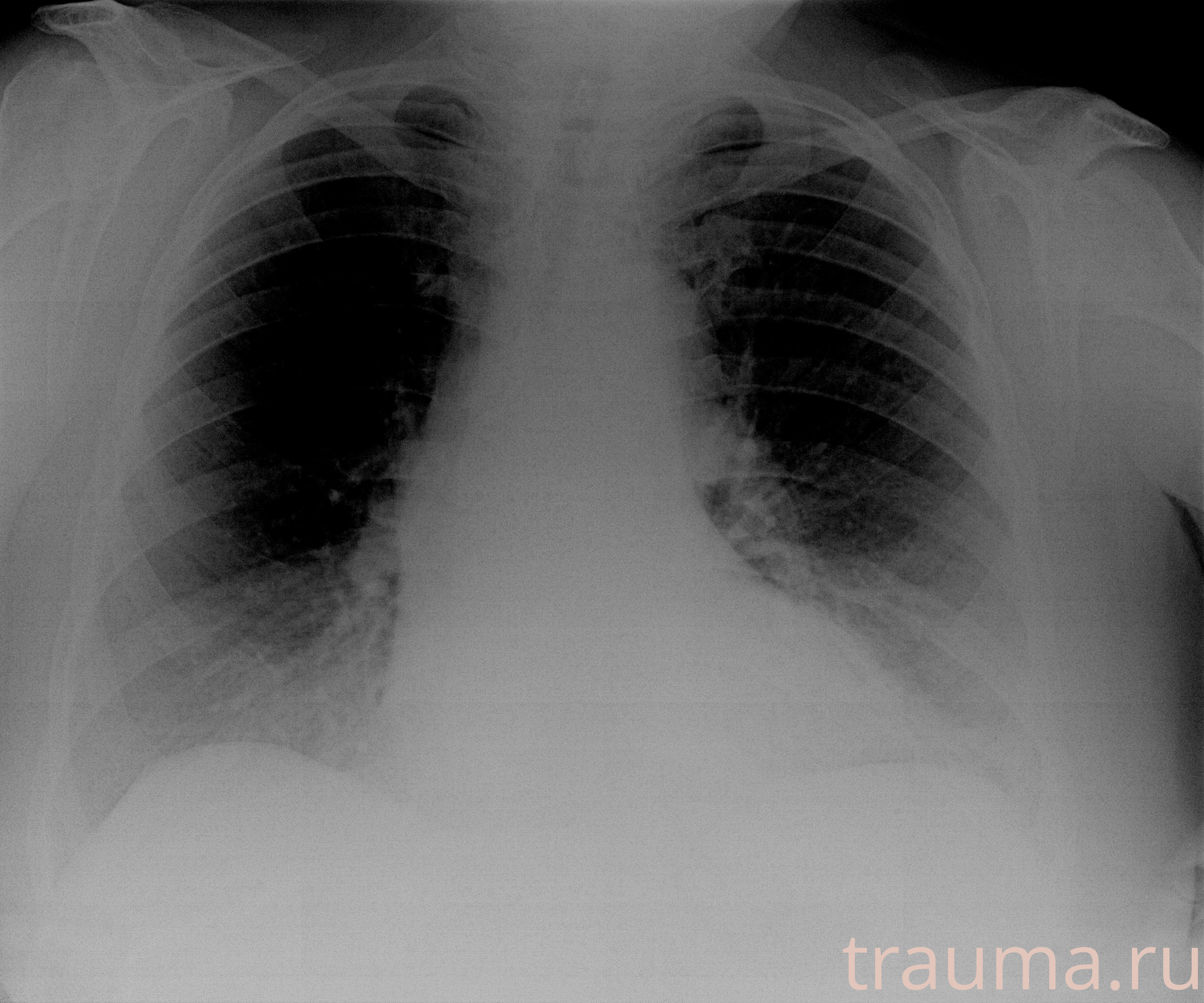 Рентген на дому: по вашему адресу приезжает врач-рентгенолог, травматолог-ортопед с мобильным рентгеновским аппаратом, проводит диагностику травмы или заболевания, делает необходимые рентгенограммы, дает рекомендации по дальнейшему лечению. Получить качественные снимки в домашних условиях возможно благодаря уникальной методике, разработанной МосРентген Центром для института  Склифосовского