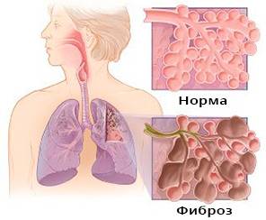 Фиброз Фиброз