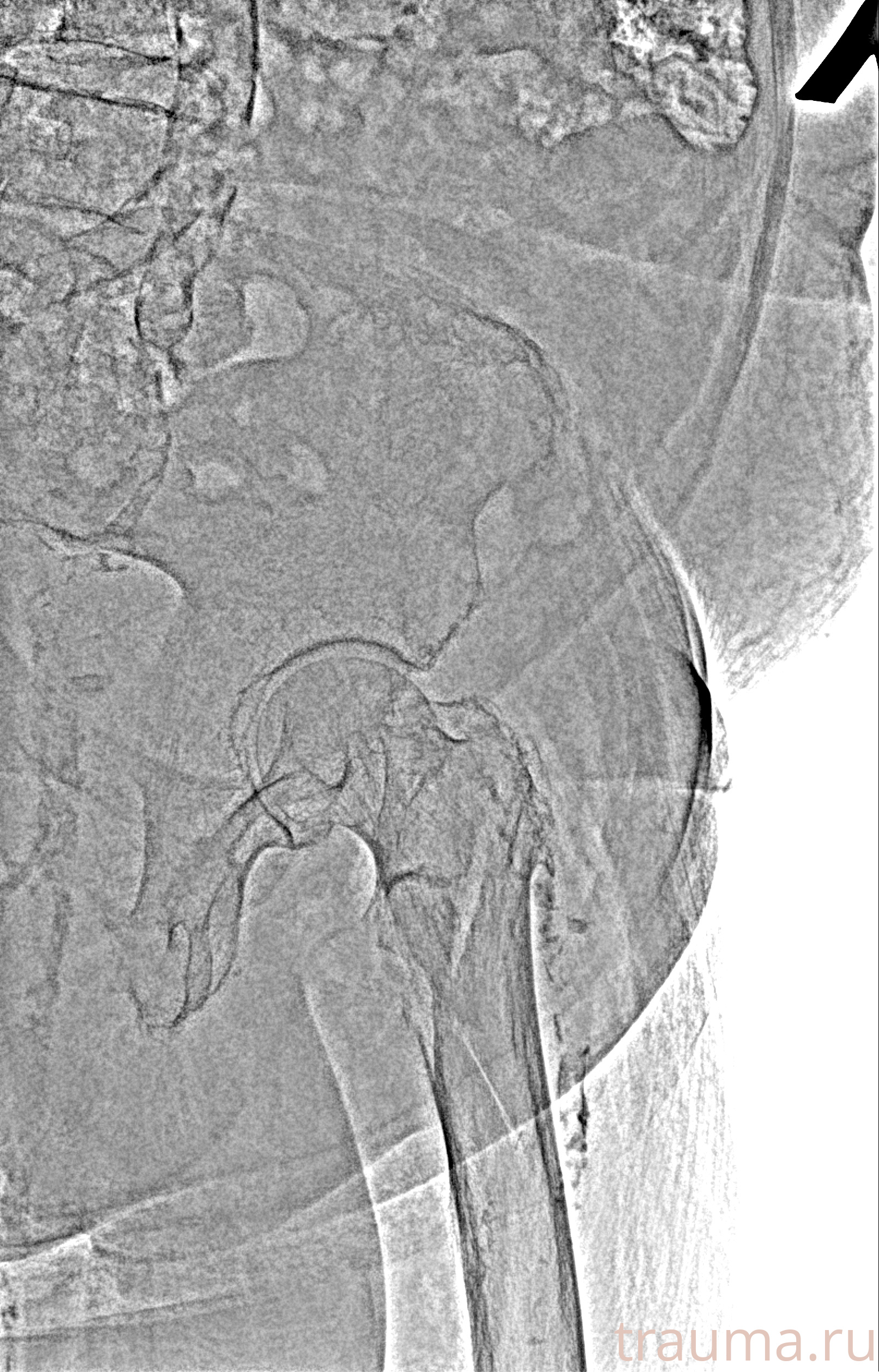 Рентген на дому: по вашему адресу приезжает врач-рентгенолог, травматолог-ортопед с мобильным рентгеновским аппаратом, проводит диагностику травмы или заболевания, делает необходимые рентгенограммы, дает рекомендации по дальнейшему лечению. Получить качественные снимки в домашних условиях возможно благодаря уникальной методике, разработанной МосРентген Центром для института  Склифосовского